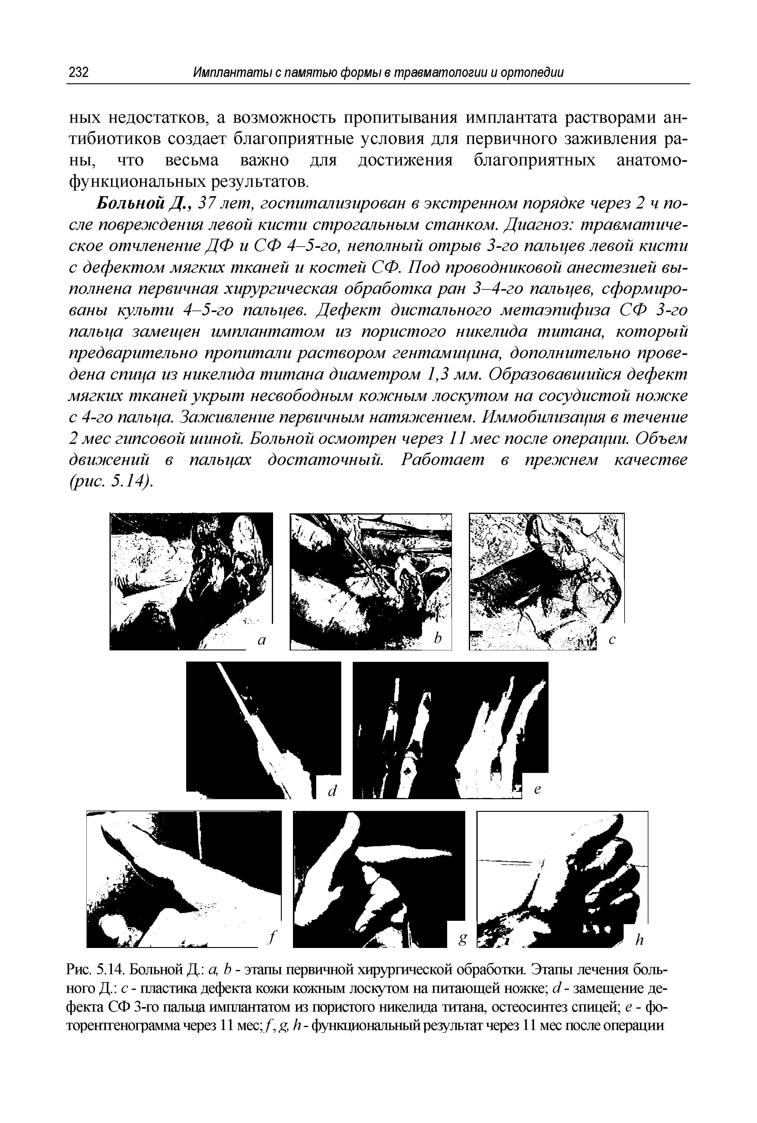 Рис. 5.14. Больной Д ц Ь - этапы первичной хирургической обработки. Этапы лечения больного Д. с - пластика дефекта кожи кожным лоскутом на питающей ножке 4 - замещение дефекта СФ 3-го пальца имплантатом из пористого никелида титана, остеосинтез спицей е - фоторентгенограмма через 11 мес /, д, А - функциональный результат через 11 мес после операции...