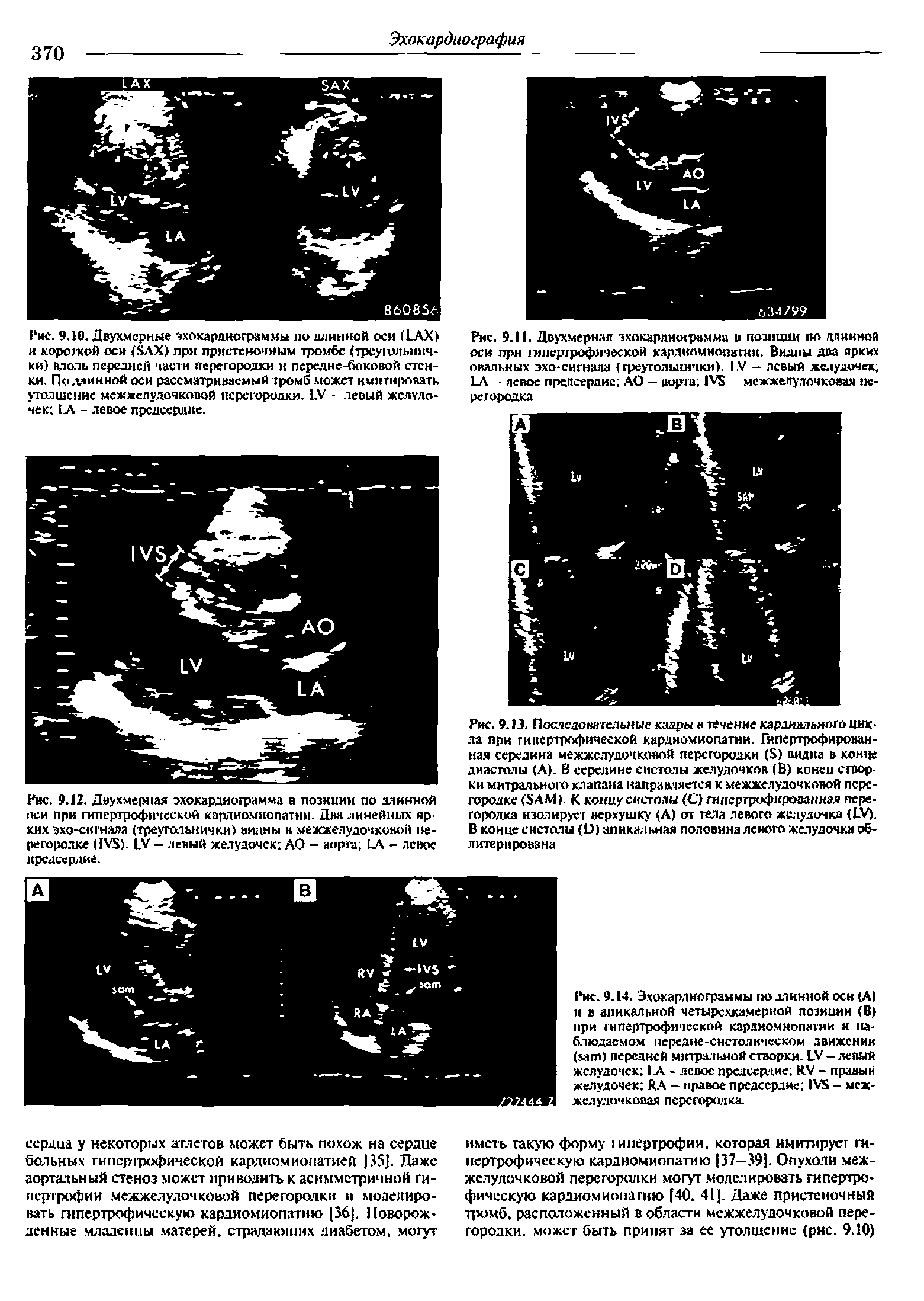 Рис. 9.И. Двухмерная эхлкардишрамми и позиции по длинной оси при 1млергрофиче>ской кардиомиопатии. Видны два ярких овальных эхо-сигнала (треугольнички). IV - левый желудочек 1 А - левое предсердие АО - порта 1 5 межжелудочковая перегородка...