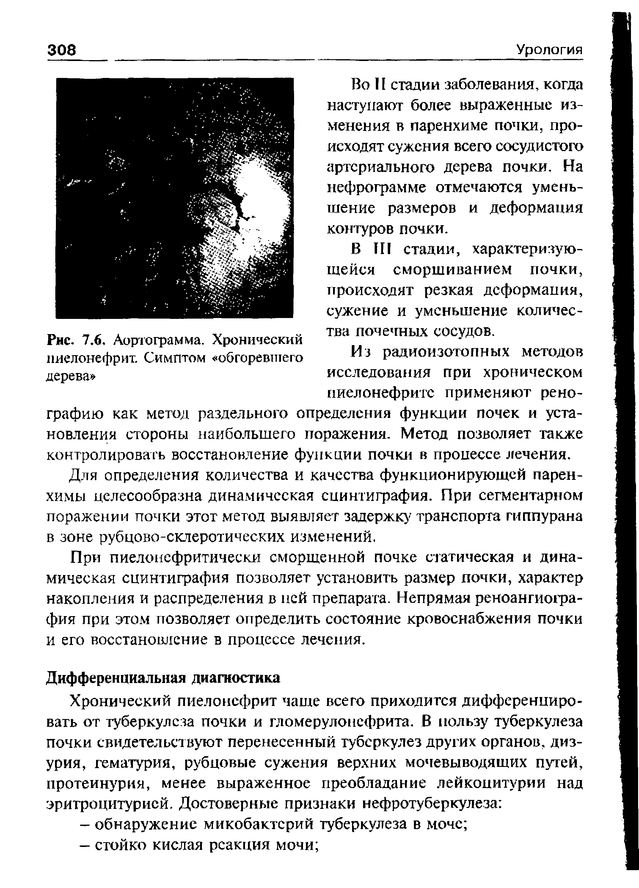 Рис. 7.6. Аортограмма. Хронический пиелонефрит. Симптом обгоревшего дерева ...