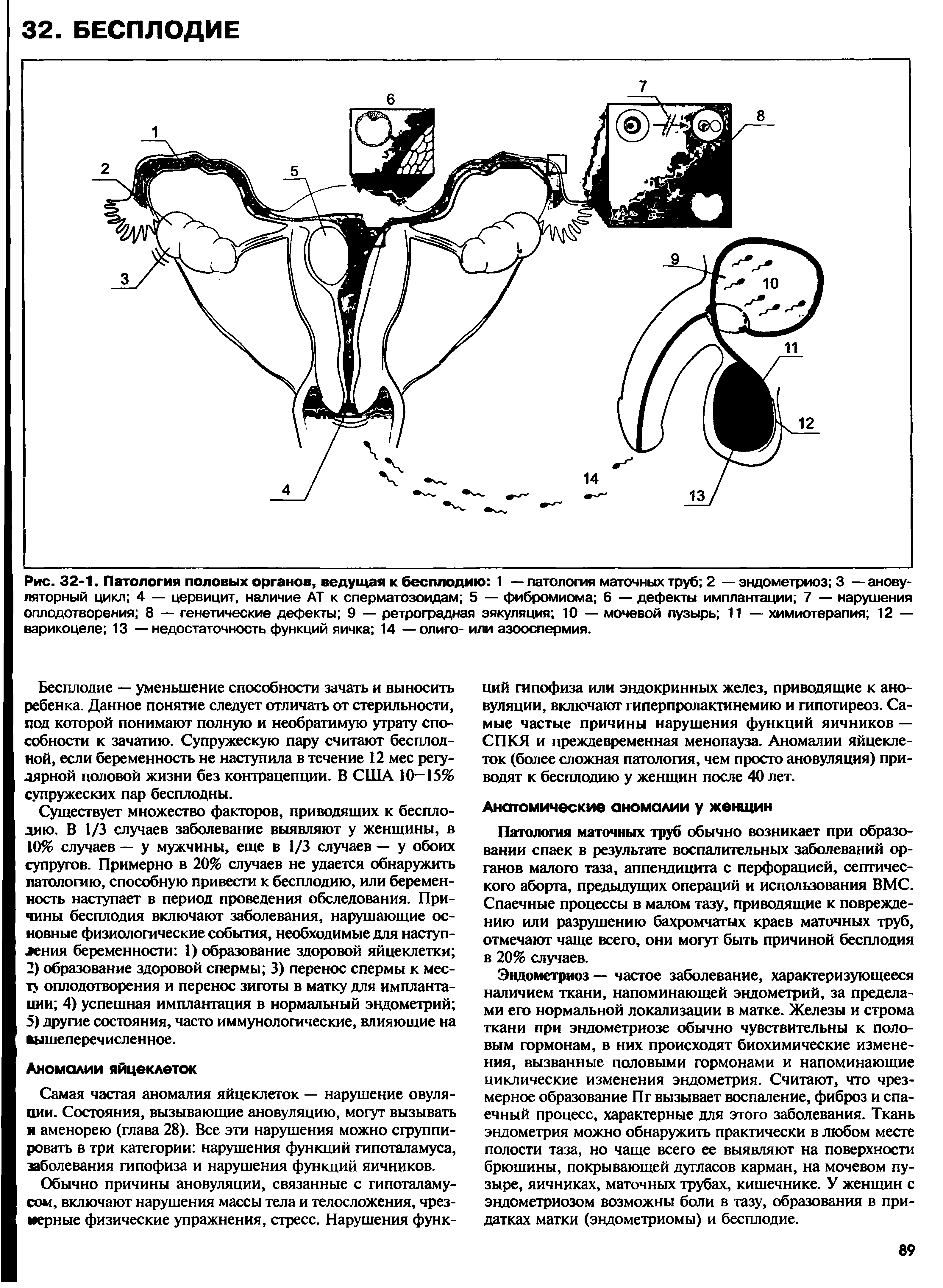 Рис. 32-1. Патология половых органов, ведущая к бесплодию 1 —патология маточных труб 2 — эндометриоз 3 — анову-ляторный цикл 4 — цервицит, наличие АТ к сперматозоидам 5 — фибромиома 6 — дефекты имплантации 7 — нарушения оплодотворения 8 — генетические дефекты 9 — ретроградная эякуляция 10 — мочевой пузырь 11 — химиотерапия 12 — варикоцеле 13 — недостаточность функций яичка 14 —олиго- или азооспермия.