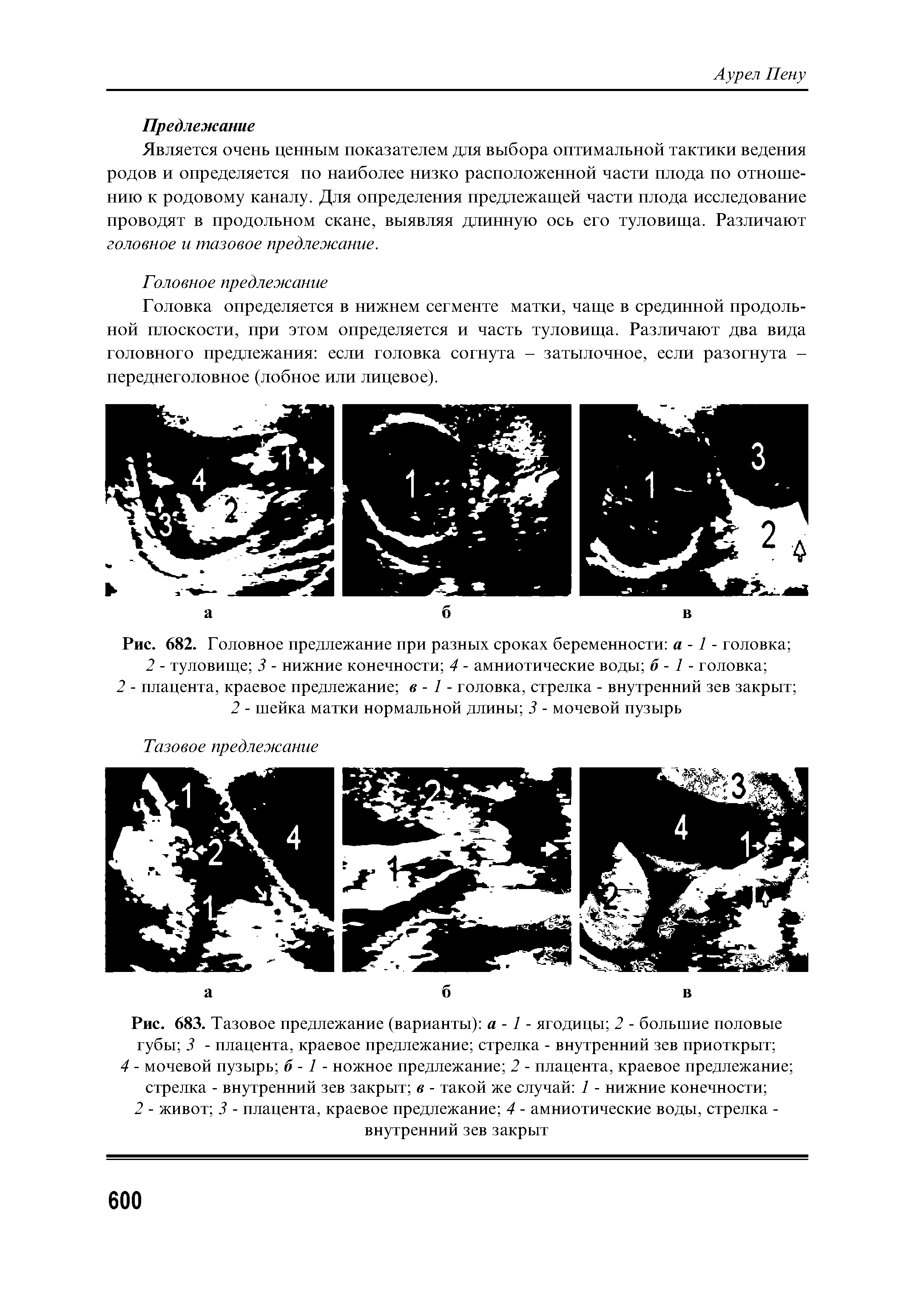 Рис. 683. Тазовое предлежание (варианты) а -1 - ягодицы 2 - большие половые губы 3 - плацента, краевое предлежание стрелка - внутренний зев приоткрыт 4 - мочевой пузырь б -1 - ножное предлежание 2 - плацента, краевое предлежание стрелка - внутренний зев закрыт в - такой же случай 1 - нижние конечности ...