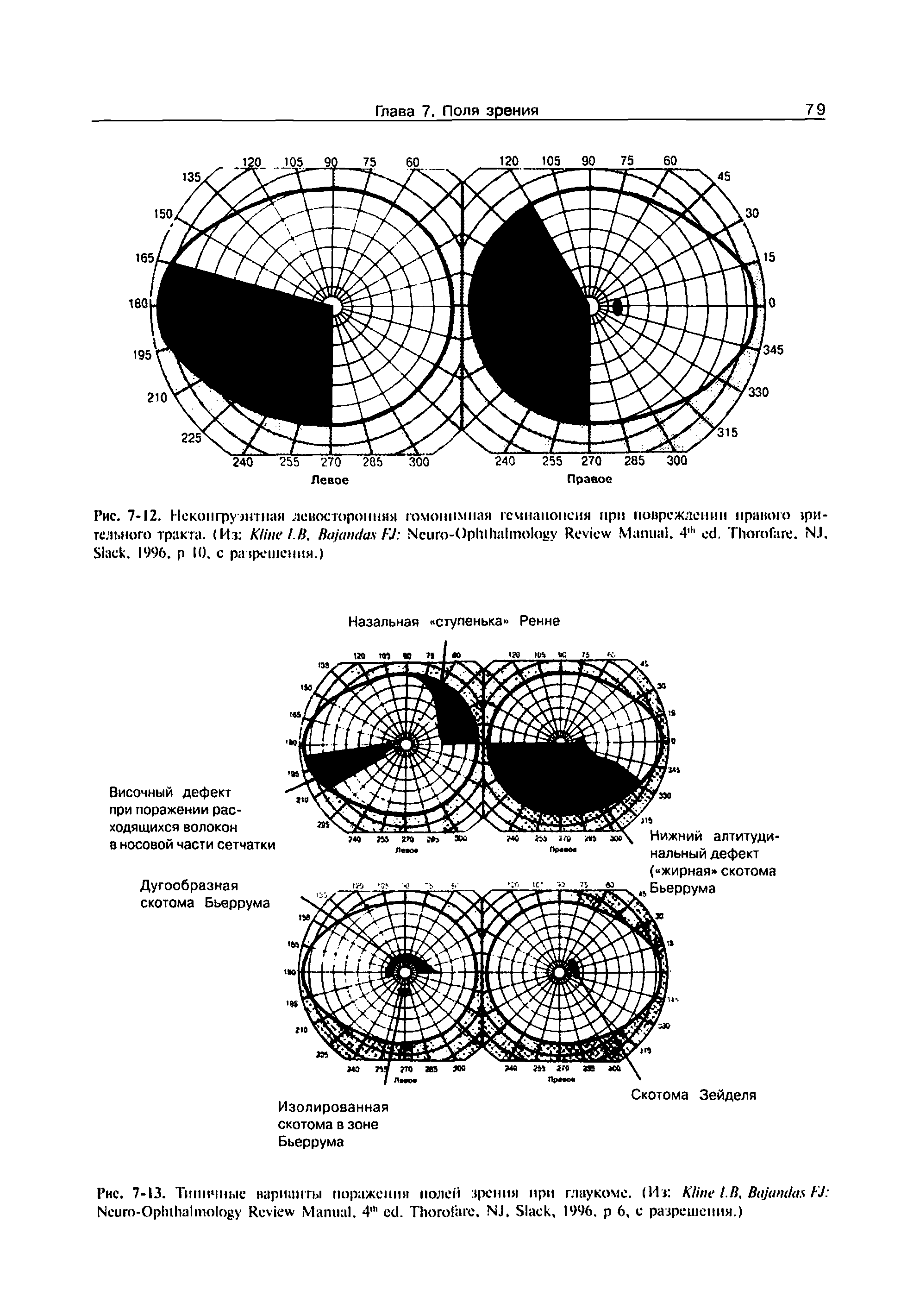 Рис. 7-13. Типичные варианты поражения полей зрения при глаукоме. (Из K LB, B KJ ...