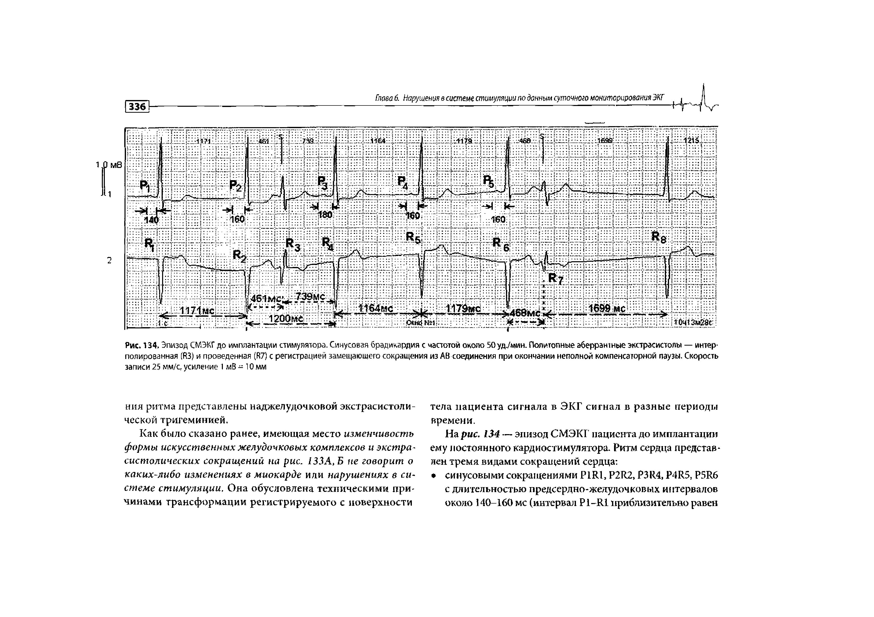 Рис. 134. Эпизод СМЭКГ до имплантации стимулятора. Синусовая брадикардия с частотой около 50уд./мин. Политопные аберрантные экстрасистолы — интерполированная (ЙЗ) и проведенная (Й7) с регистрацией замещающего сокращения из АВ соединения при окончании неполной компенсаторной паузы. Скорость записи 25 мм/с, усиление 1 мВ - 10 мм...