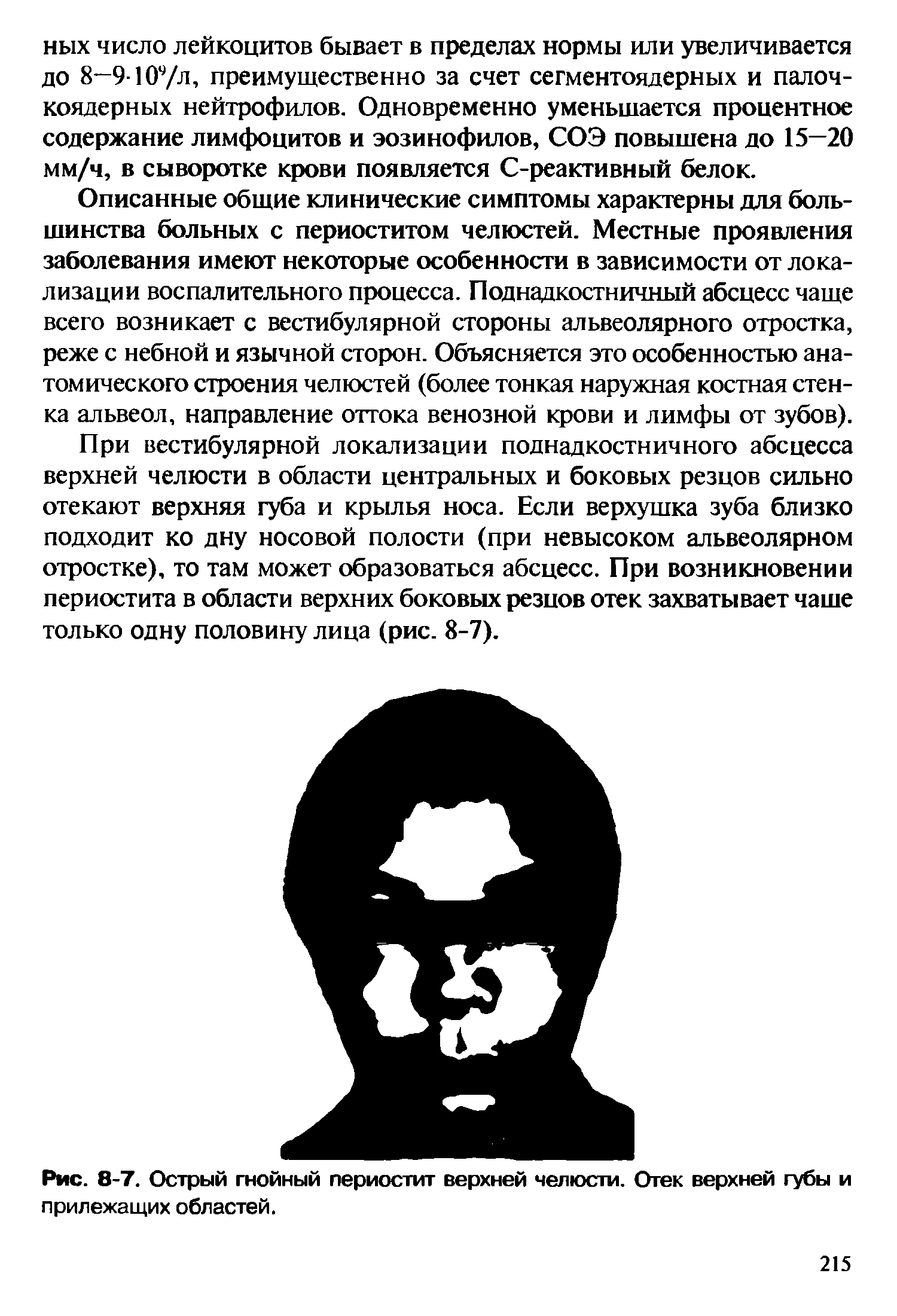 Рис. 8-7. Острый гнойный периостит верхней челюсти. Отек верхней губы и прилежащих областей.