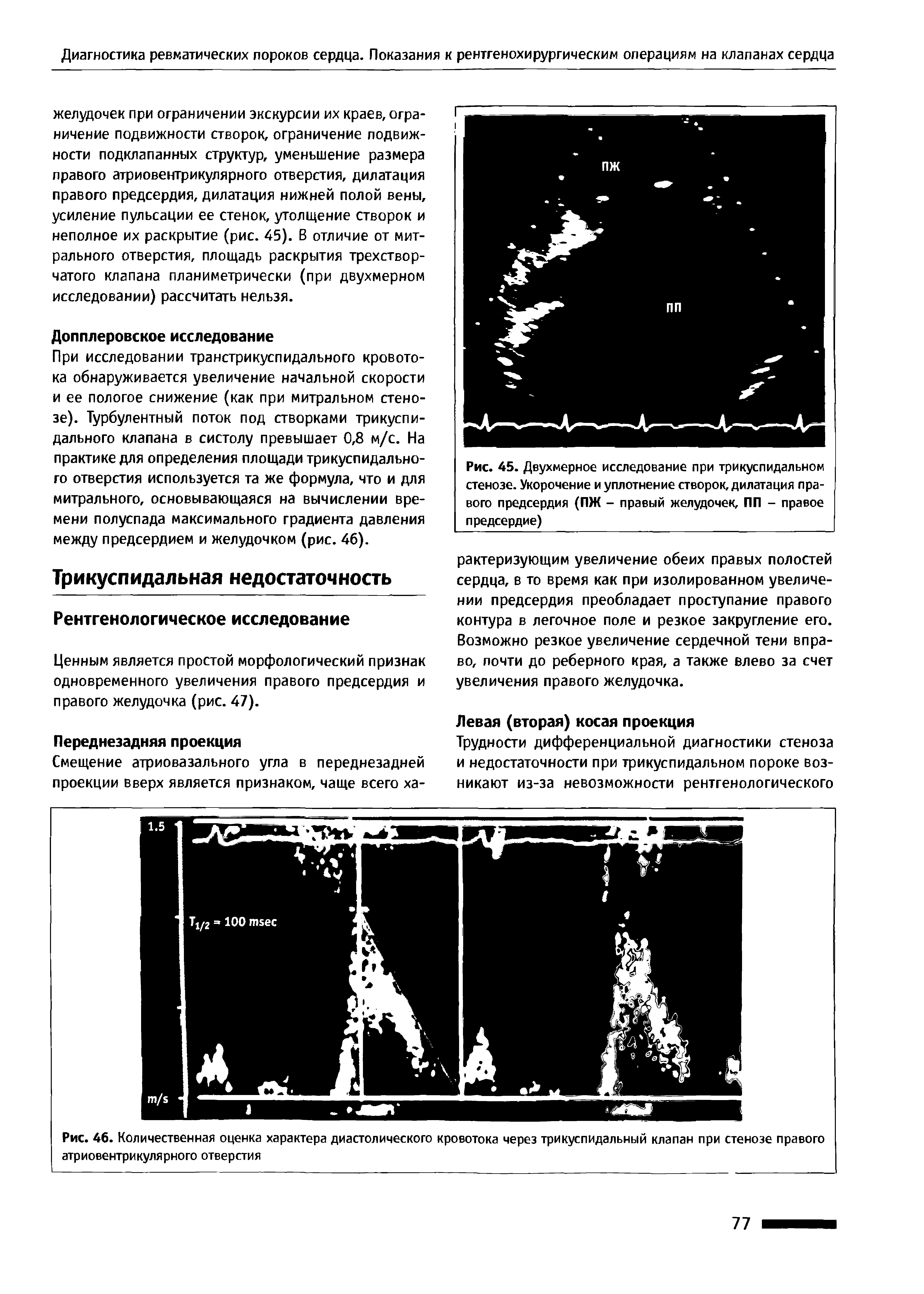Рис. 46. Количественная оценка характера диастолического кровотока через трикуспидальный клапан при стенозе правого атриовентрикулярного отверстия...