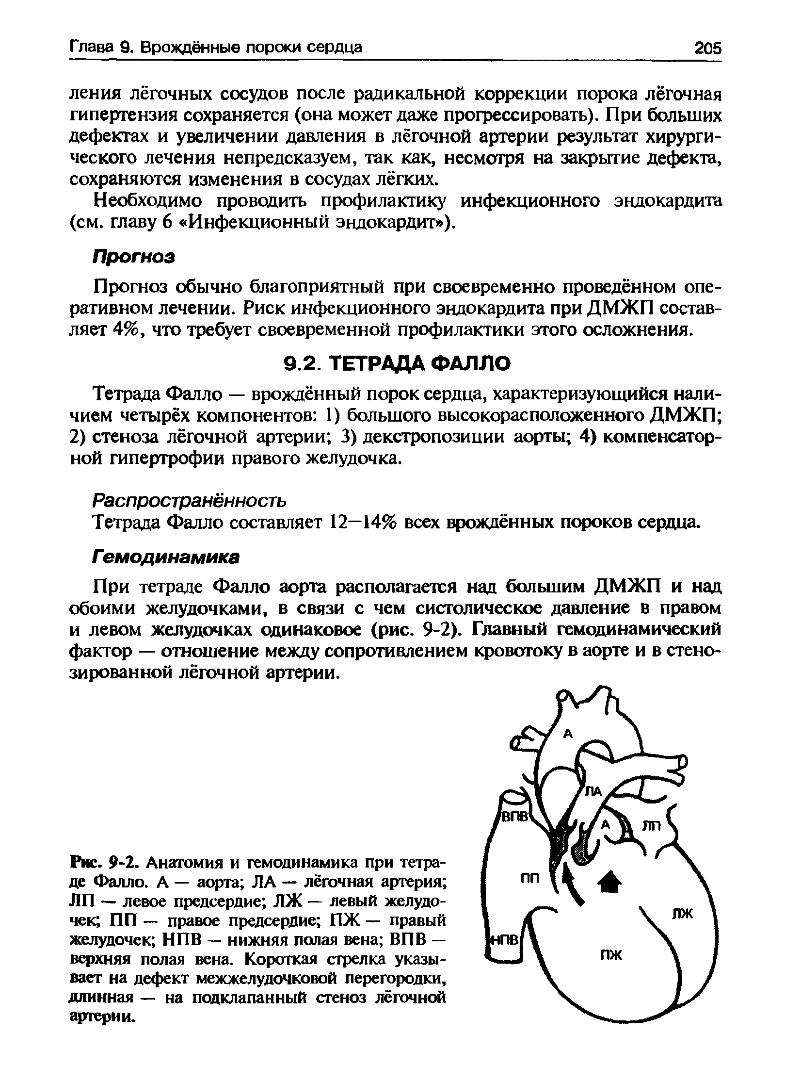 Рис. 9-2. Анатомия и гемодинамика при тетраде Фалло. А — аорта ЛА — лёгочная артерия ЛП — левое предсердие ЛЖ — левый желудочек ПП — правое предсердие ПЖ — правый желудочек НПВ — нижняя полая вена ВПВ — верхняя полая вена. Короткая стрелка указывает на дефект межжелудочковой перегородки, длинная — на подклапанный стеноз лёгочной артерии.