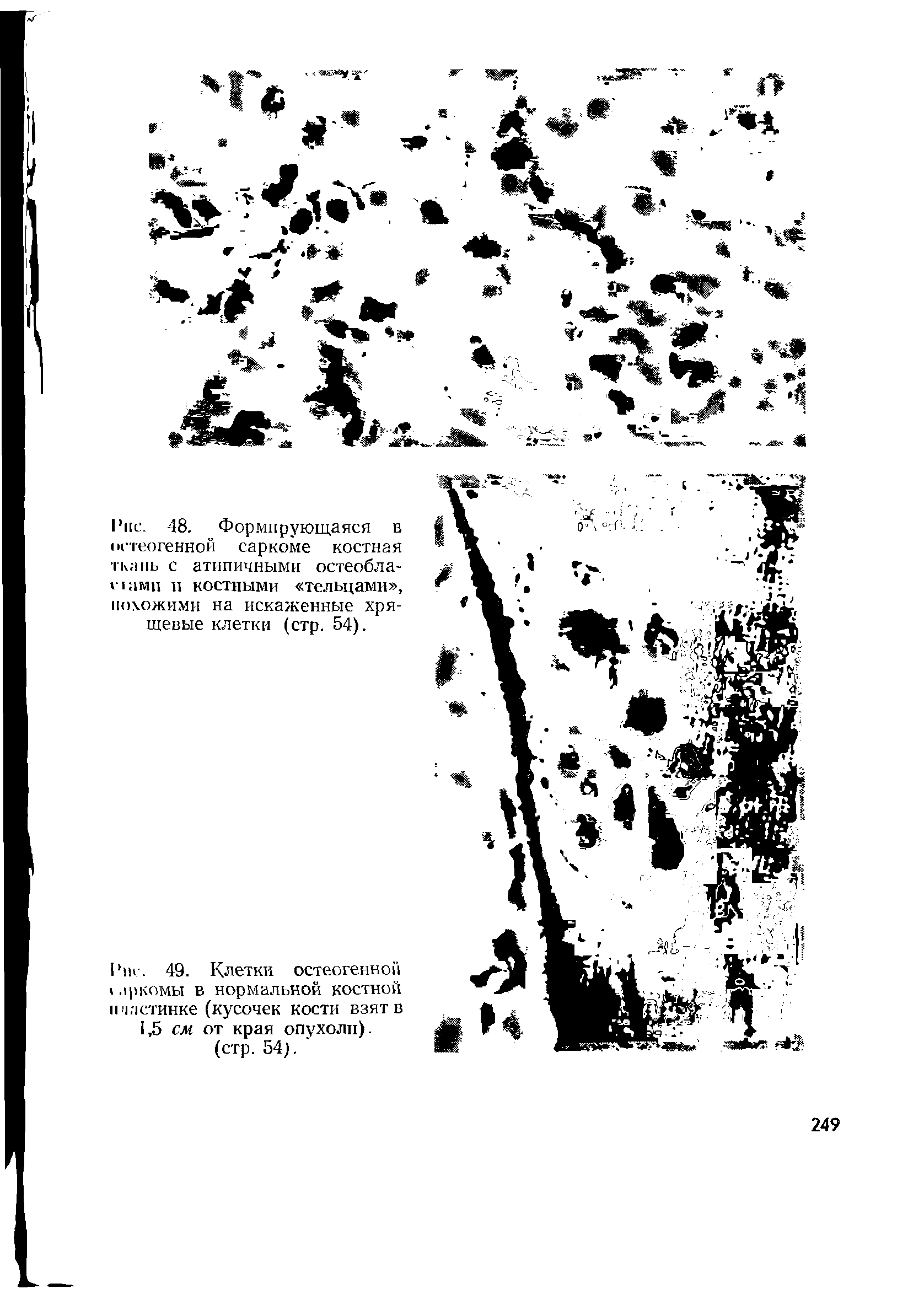 Рис. 49. Клетки остеогенной лркомы в нормальной костной нчастинке (кусочек кости взят в 1,5 см от края опухоли), (стр. 54).