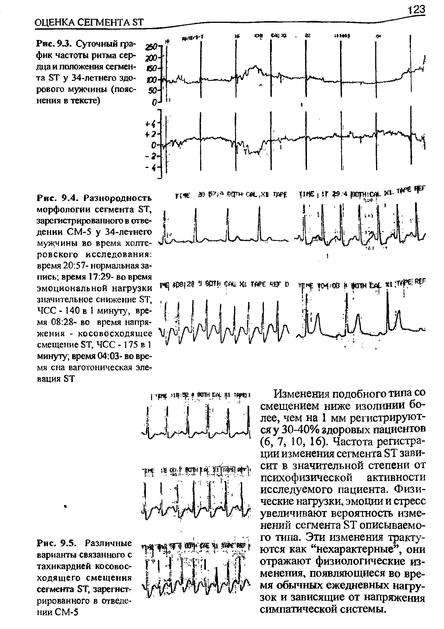Рис. 9.4. Разнородность морфологии сегмента БТ, зарегистрированного в отведении СМ-5 у 34-летнего мужчины во время холтеровского исследования время 20 57- нормальная запись время 17 29- во время эмоциональной нагрузки значительное снижение БТ, ЧСС - 140 в 1 минуту, время 08 28- во время напряжения - косовосходящее смещение БТ, ЧСС -175 в 1 минуту время 04 03- во время сна ваготоническая элевация БТ...