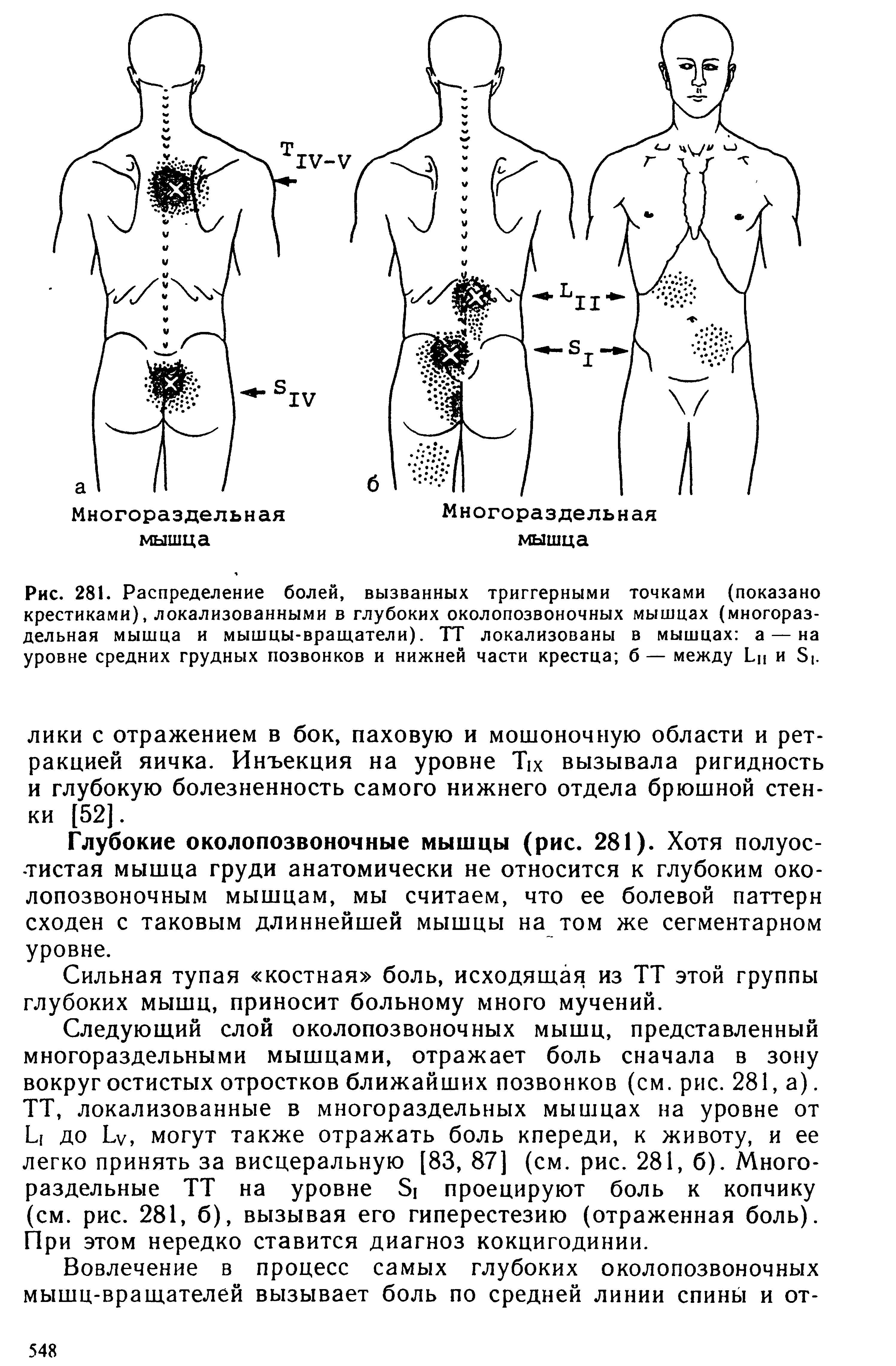 Рис. 281. Распределение болей, вызванных триггерными точками (показано крестиками), локализованными в глубоких околопозвоночных мышцах (многораздельная мышца и мышцы-вращатели). ТТ локализованы в мышцах а — на уровне средних грудных позвонков и нижней части крестца б— между Ьп и Бь...