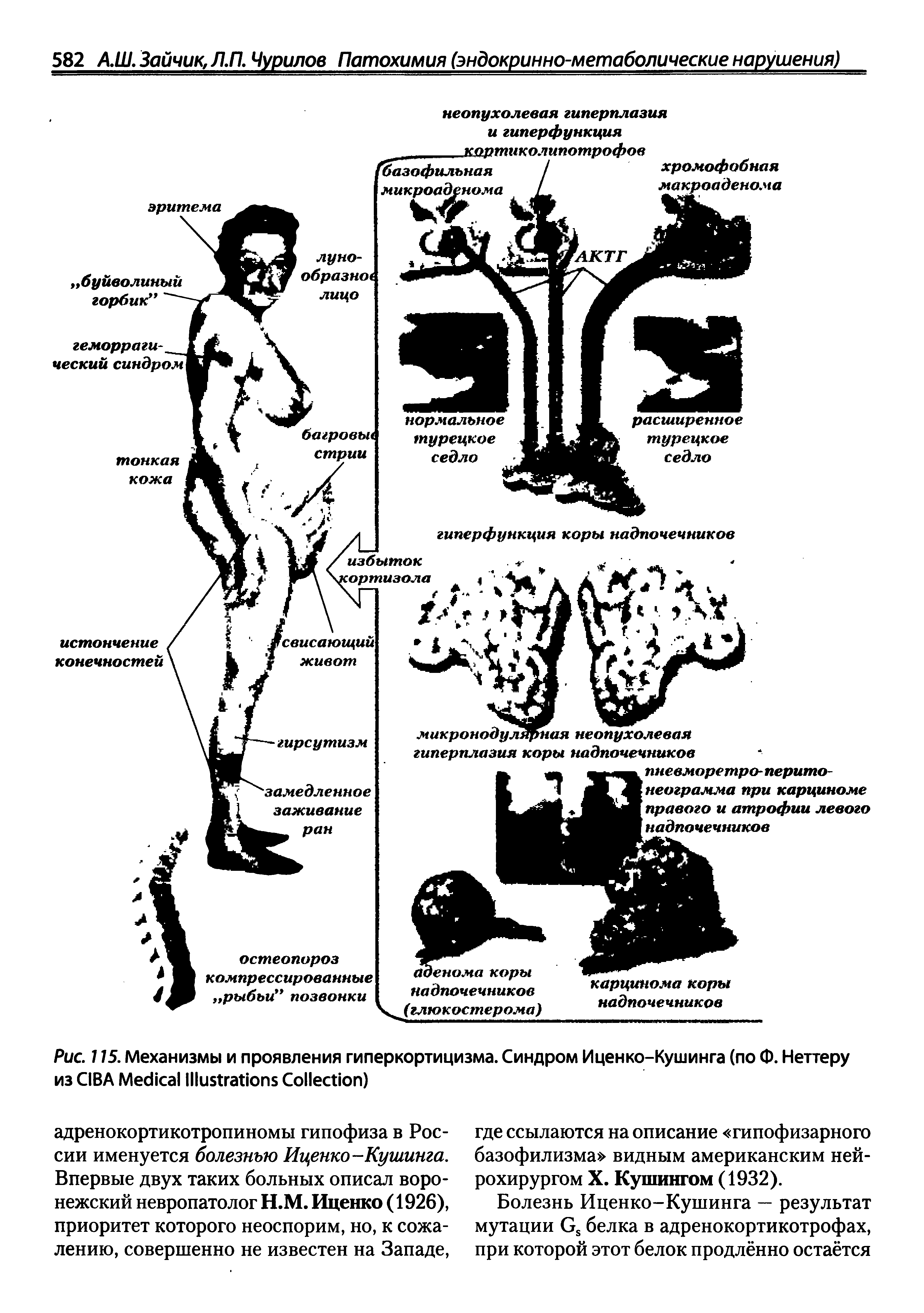 Рис. 115. Механизмы и проявления гиперкортицизма. Синдром И ценко-Кушинга (по Ф. Неттеру из CIBA M I C )...