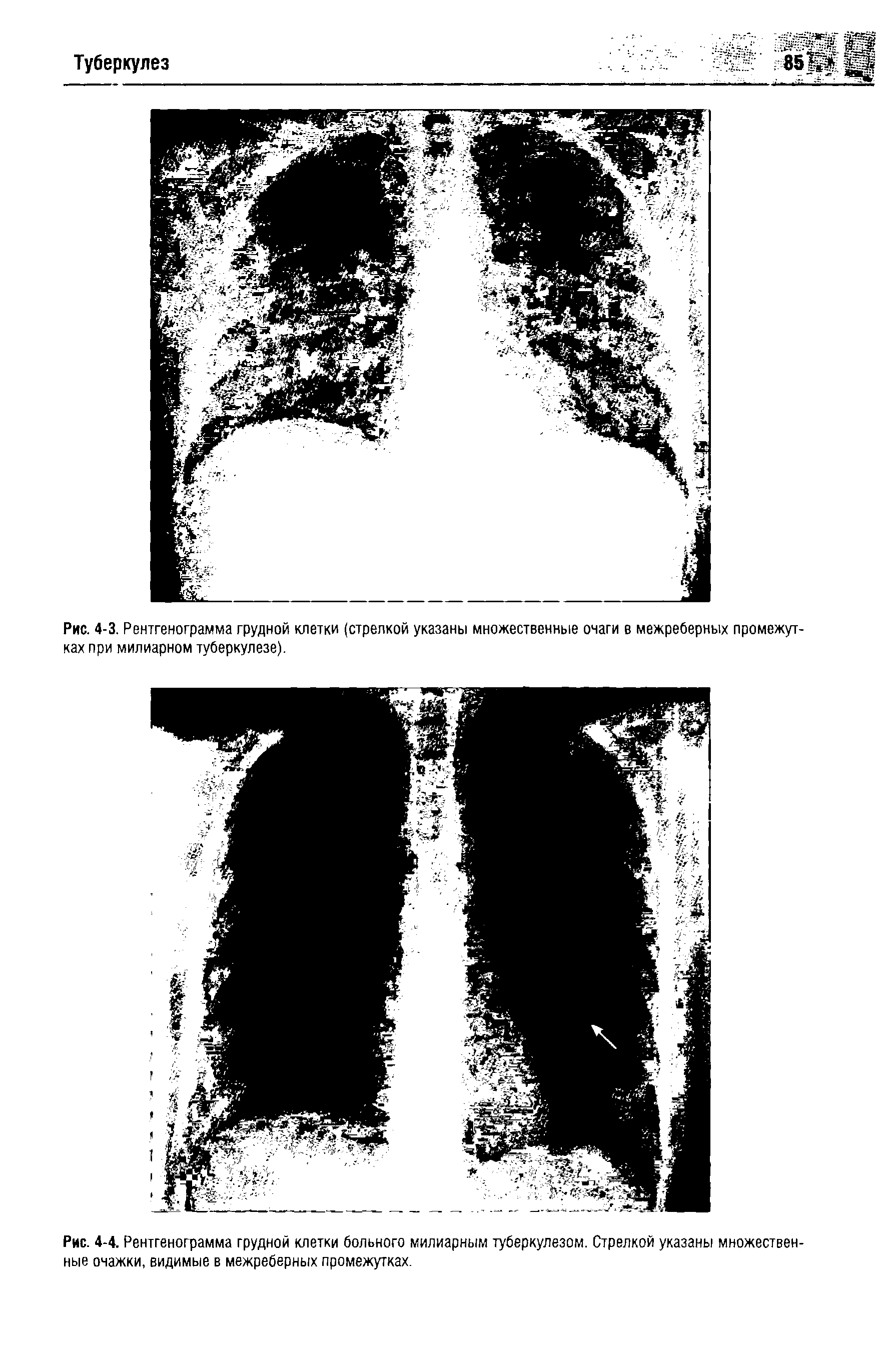 Рис. 4-3. Рентгенограмма грудной клетки (стрелкой указаны множественные очаги в межреберных промежутках при милиарном туберкулезе).