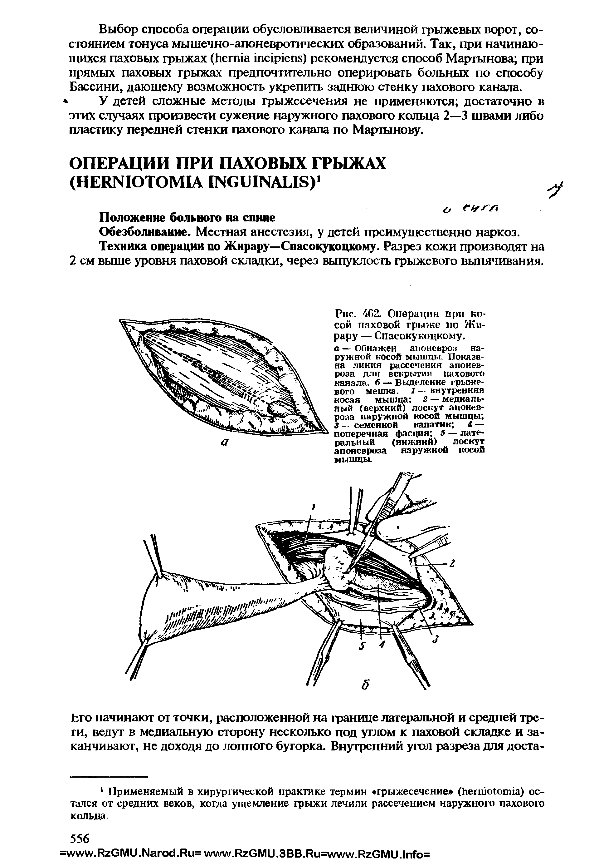 Рис. 462. Операция при косой паховой грыже по Жирару — Спасокукоцкому.