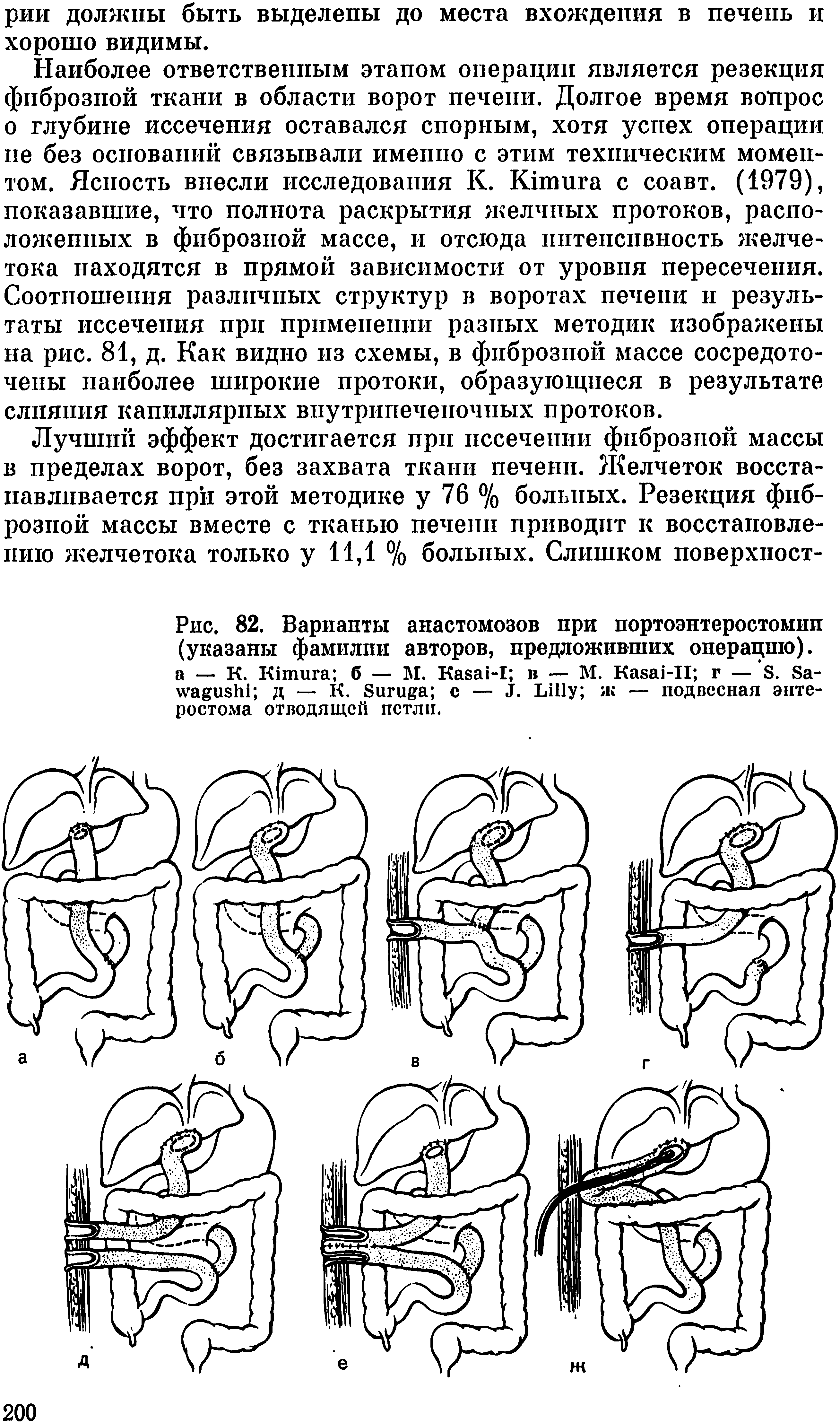 Рис. 82. Вариапты анастомозов при портоэнтеростомии (указаны фамилии авторов, предложивших операцию), а — К. K б — М. K -I в — М. K -II г — S. S - д — К. S с — J. L ж — подвесная эпте-ростохма отводящей петли.