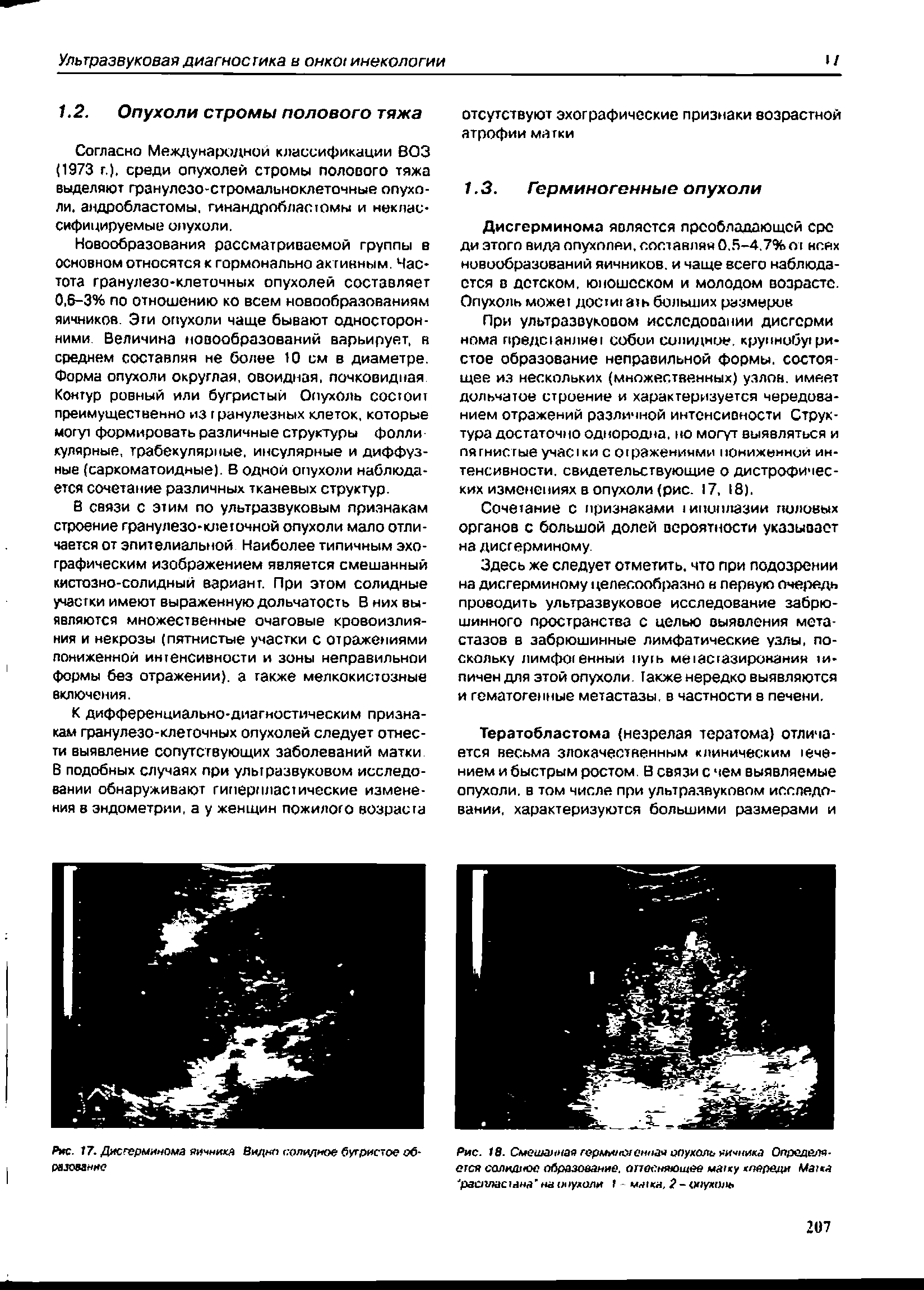 Рис. 18. Смеш маягерми/пменная опухоль яичника Оп/хд лэ-ется солидное образование. апееняюшее маиу кпереди Матса расттласына на опухоли 1 - матка, 2 - опухоль...