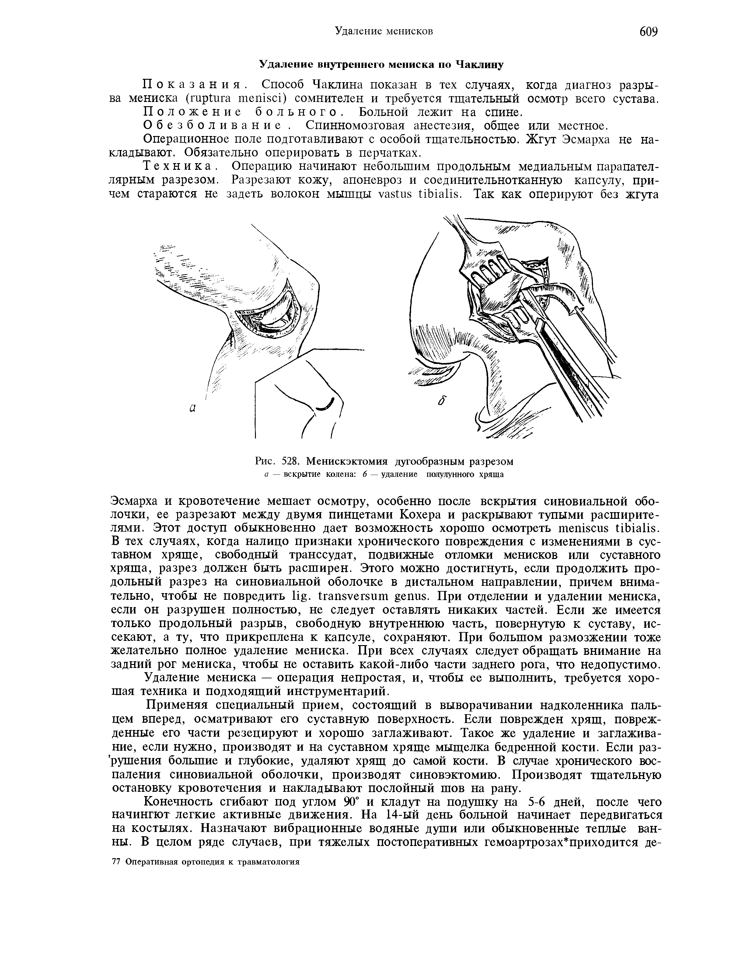 Рис. 528. Менискэктомия дугообразным разрезом а — вскрытие колена 6 — удаление полулунного хряша...