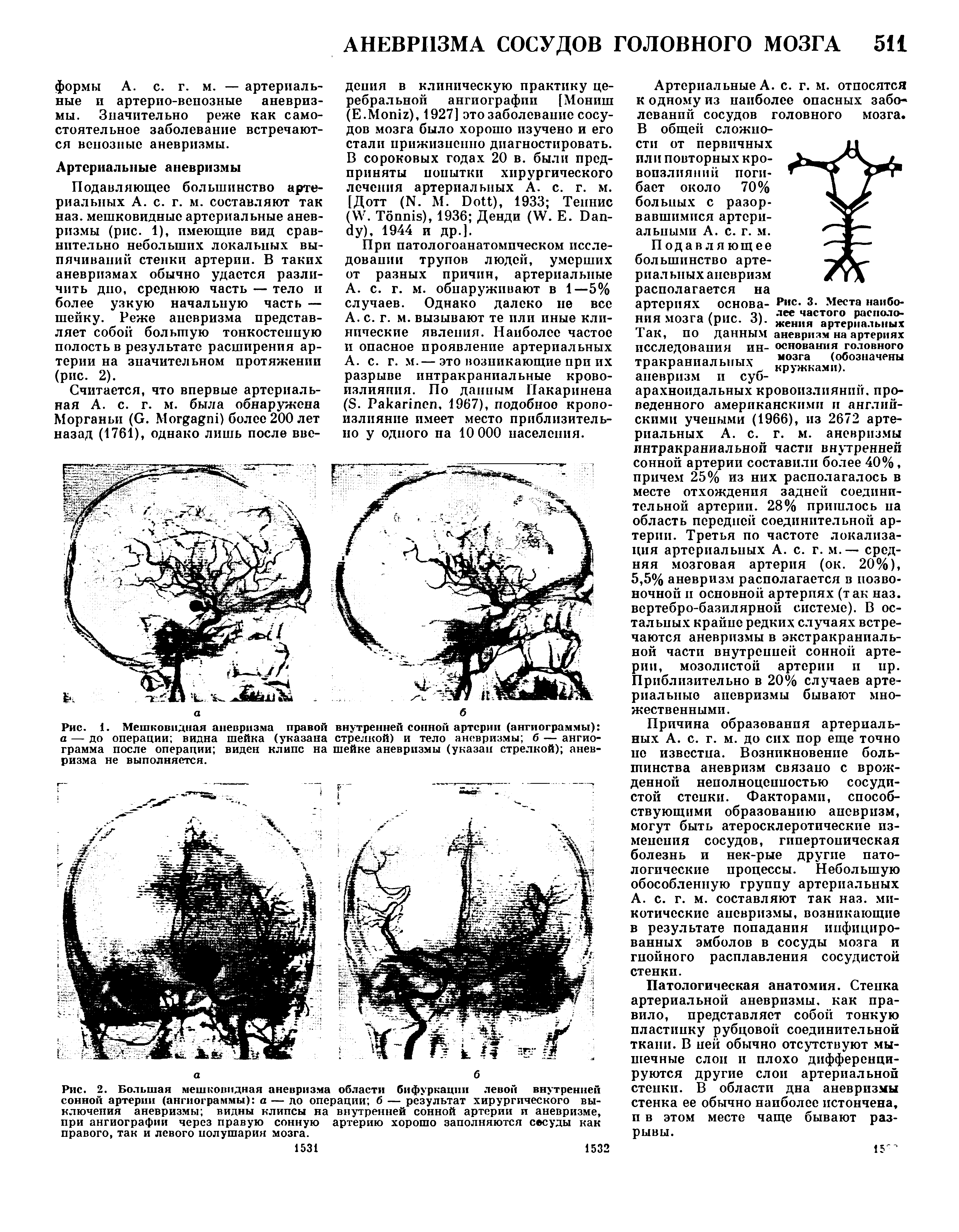 Рис. 1. Мешковидная аневризма правой внутренней сонной артерии (ангиограммы) а — до операции видна шейка (указана стрелкой) и тело аневризмы б — ангиограмма после операции виден клипс на шейке аневризмы (указан стрелкой) аневризма не выполняется.