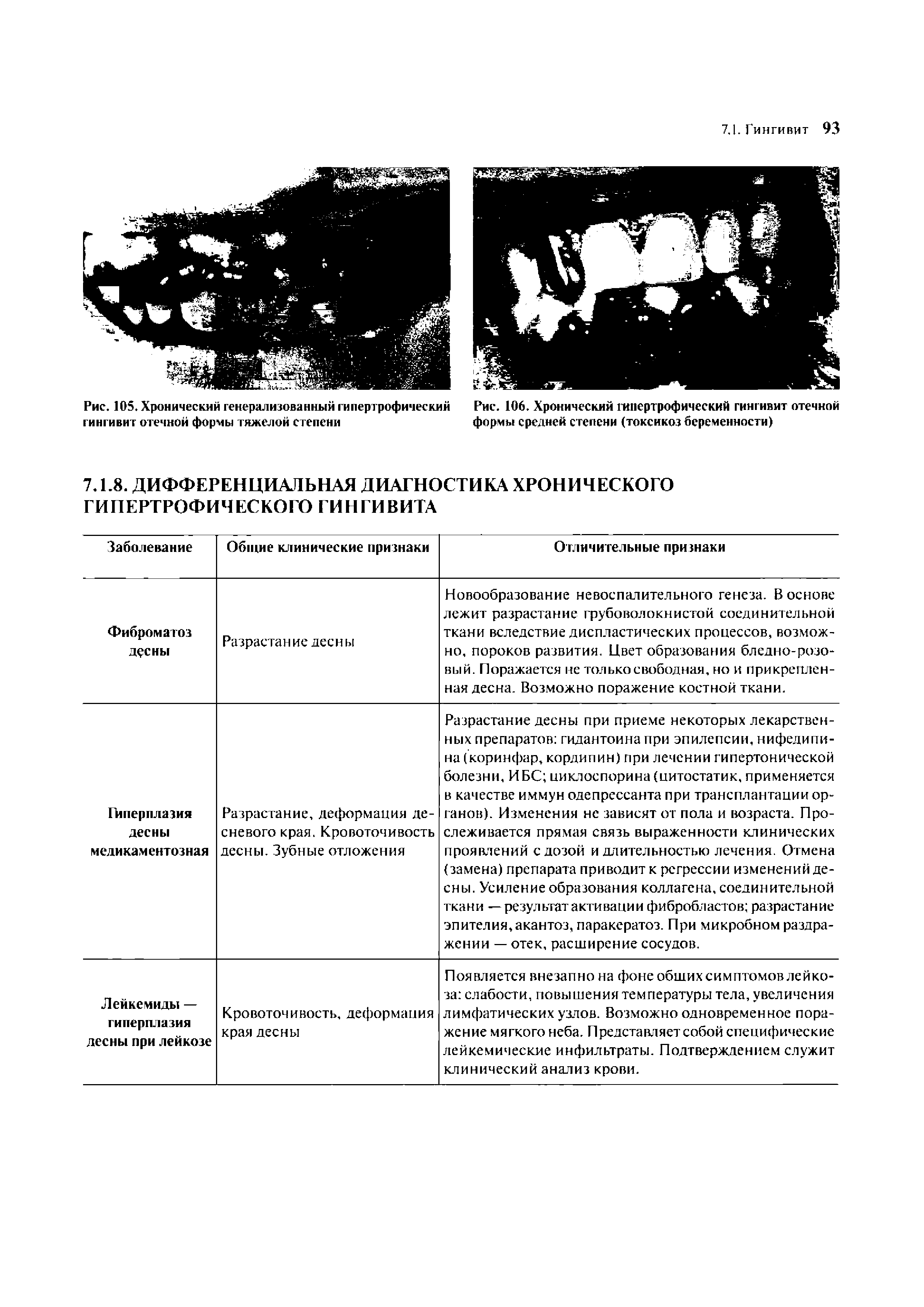 Рис. 106. Хронический гипертрофический гингивит отечной формы средней степени (токсикоз беременности)...