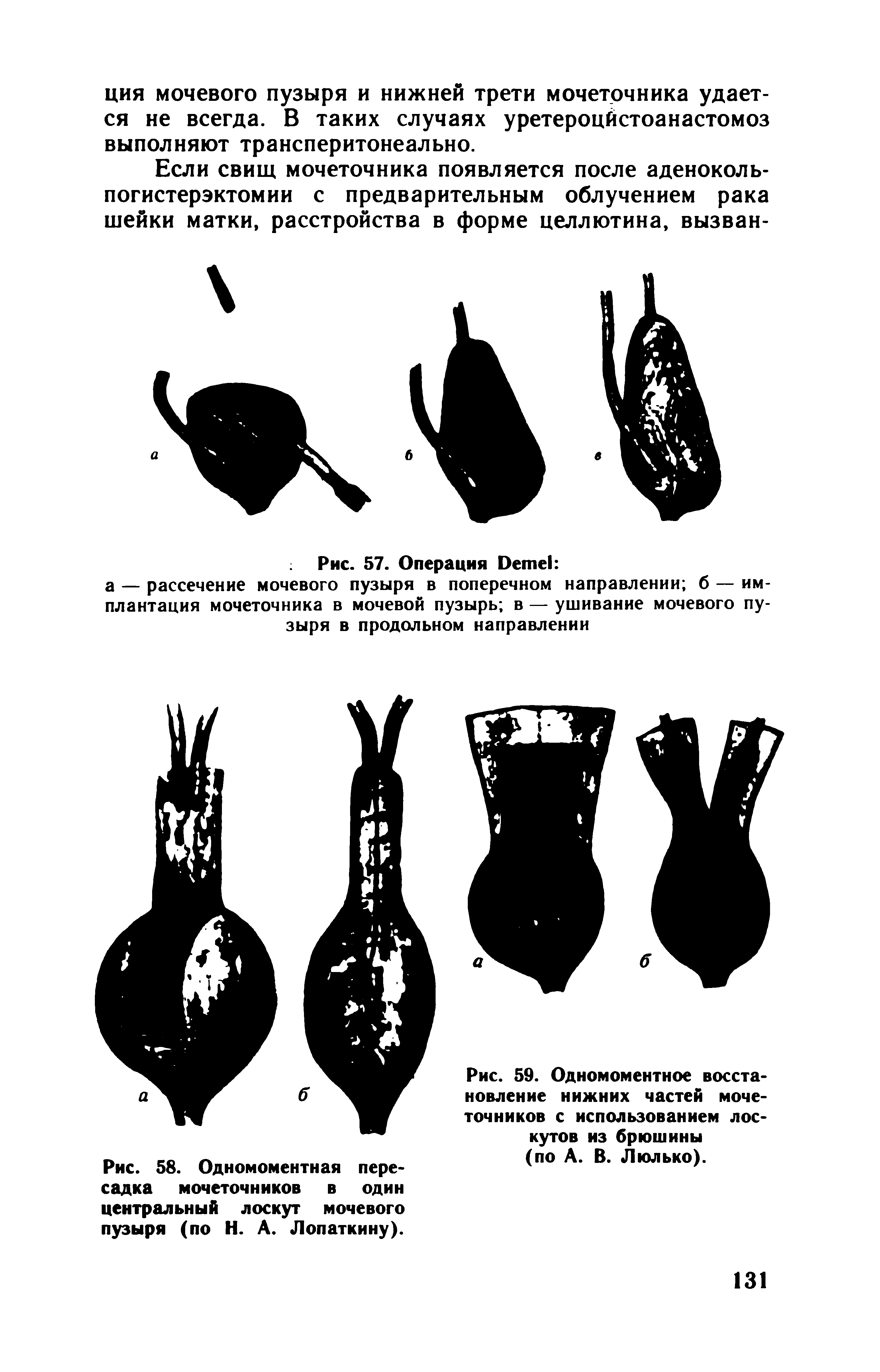 Рис. 59. Одномоментное восстановление нижних частей мочеточников с использованием лоскутов из брюшины (по А. В. Л юл ь ко).