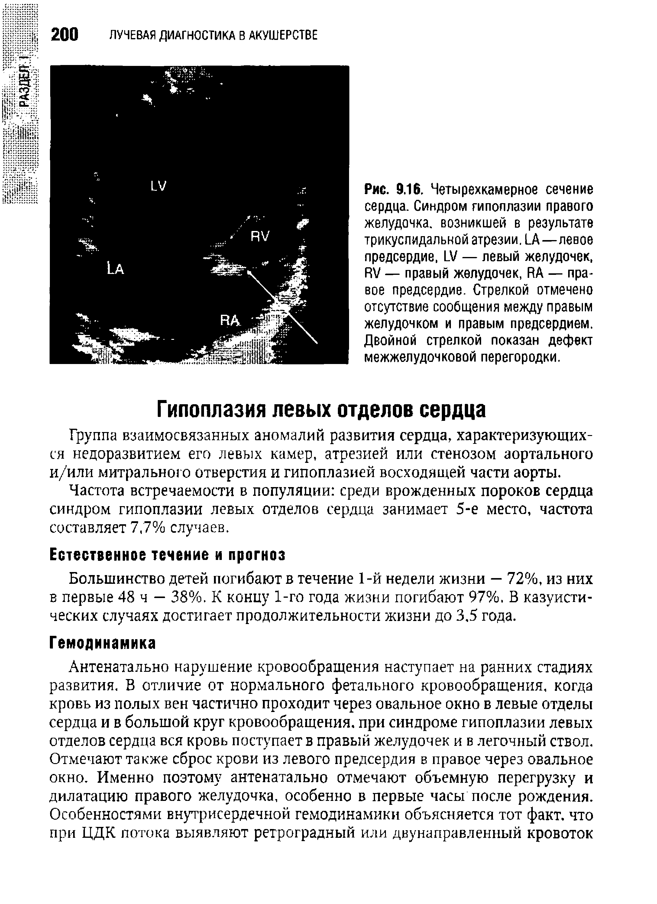 Рис. 9.16. Четырехкамерное сечение сердца. Синдром гипоплазии правого желудочка, возникшей в результате трикуспидальной атрезии, 1.А—левое предсердие, 1 / — левый желудочек, К / — правый желудочек, ЙА — правое предсердие. Стрелкой отмечено отсутствие сообщения между правым желудочком и правым предсердием. Двойной стрелкой показан дефект межжелудочковой перегородки.