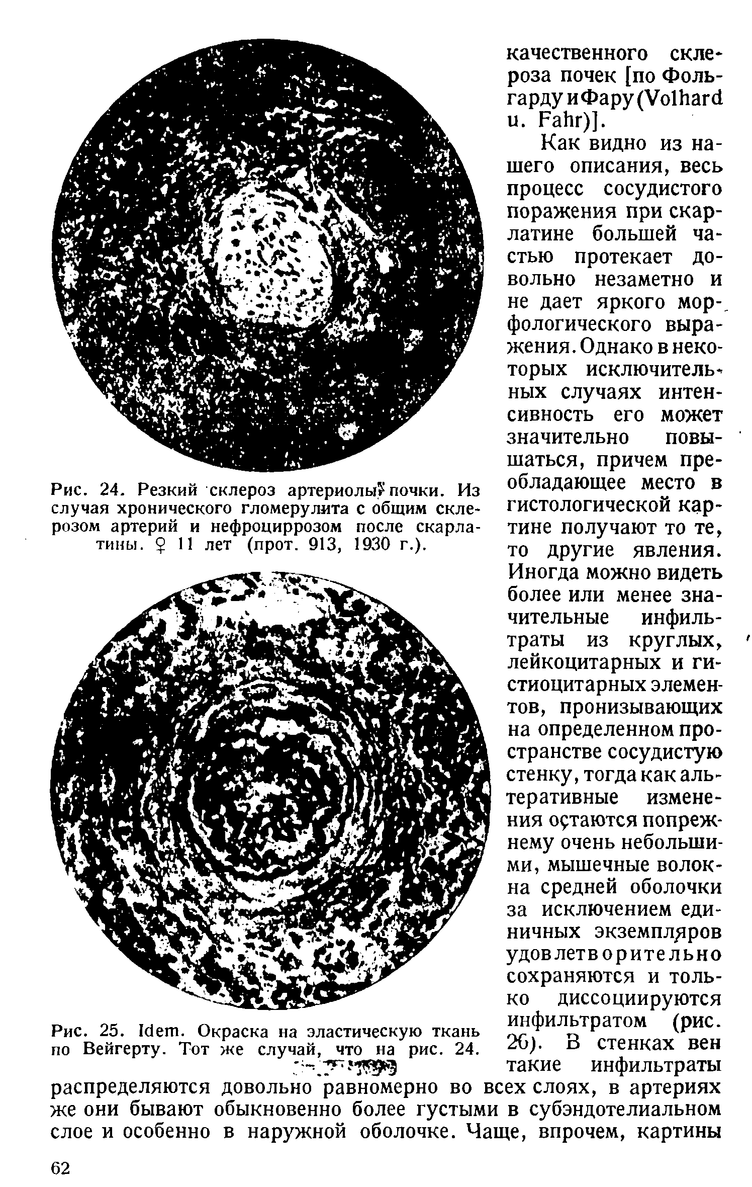 Рис. 25. I . Окраска на эластическую ткань по Вейгерту. Тот же случай, что на рис. 24.