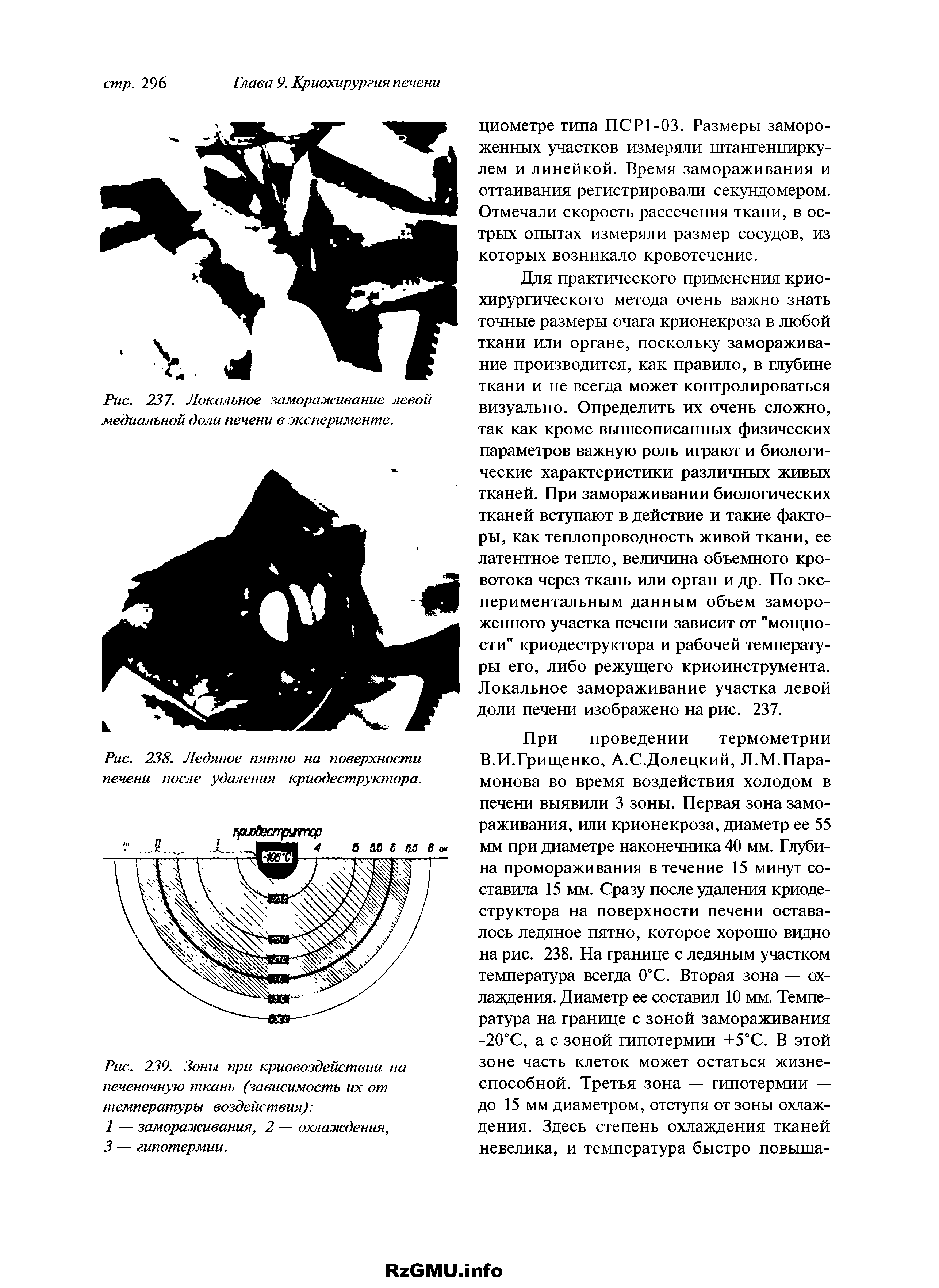 Рис. 239. Зоны при криовоздействии на печеночную ткань (зависимость их от температуры воздействия) ...