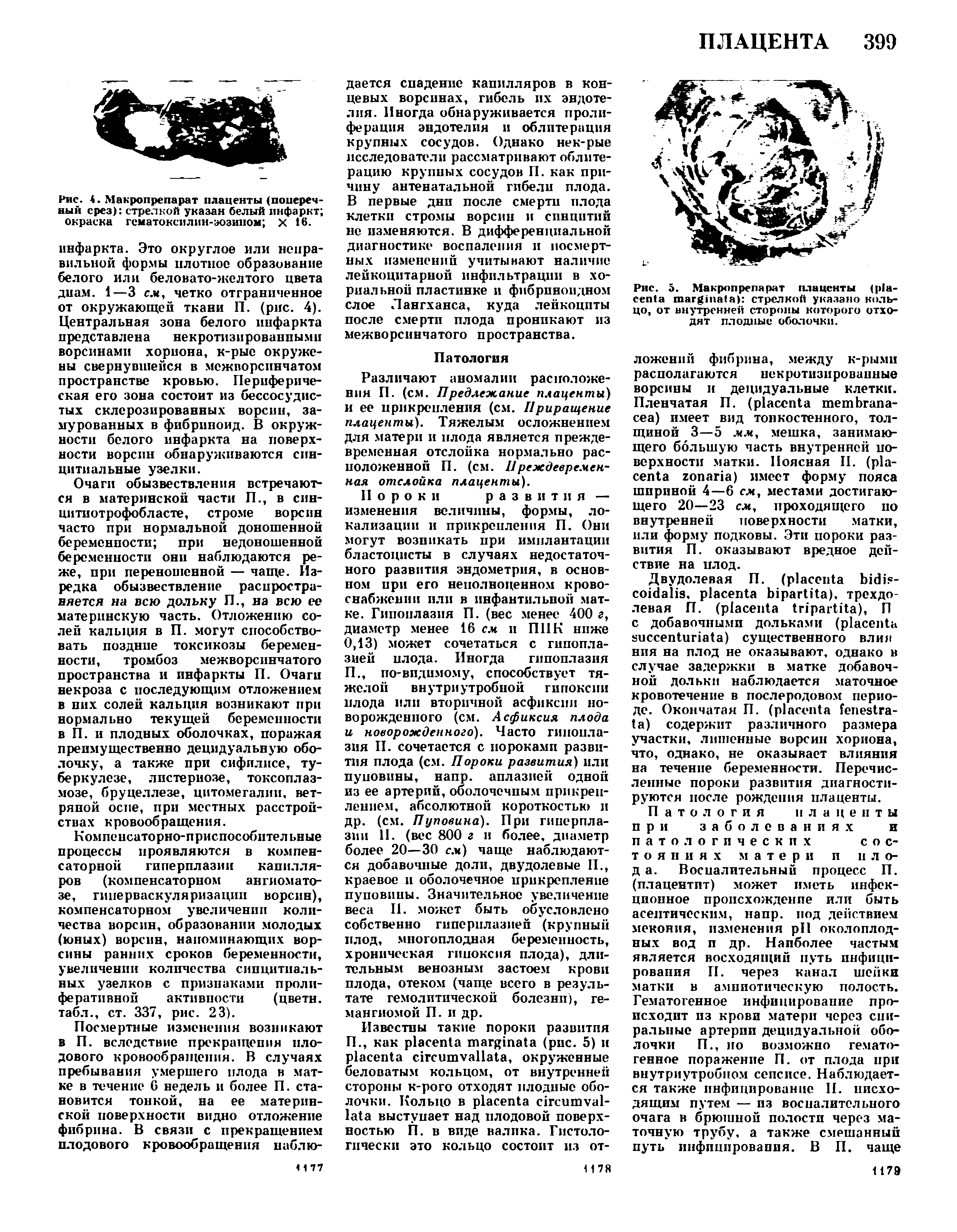 Рис. 5. Макропрепарат плаценты ( а) стрелкой указано кольцо, от внутренней стороны которого отходят плодные оболочки.