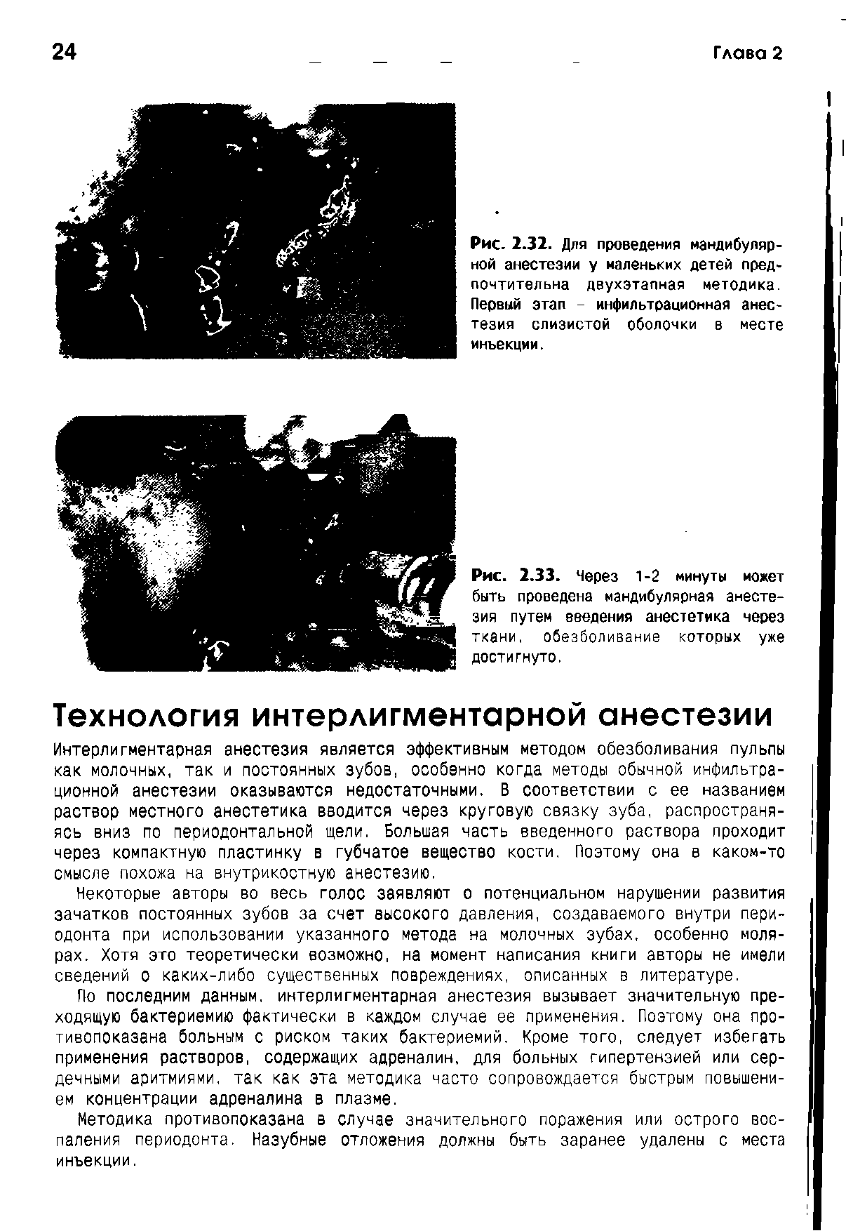 Рис. 2.33. Через 1-2 минуты может быть проведена мандибулярная анестезия путем введения анестетика через ткани, обезболивание которых уже достигнуто.