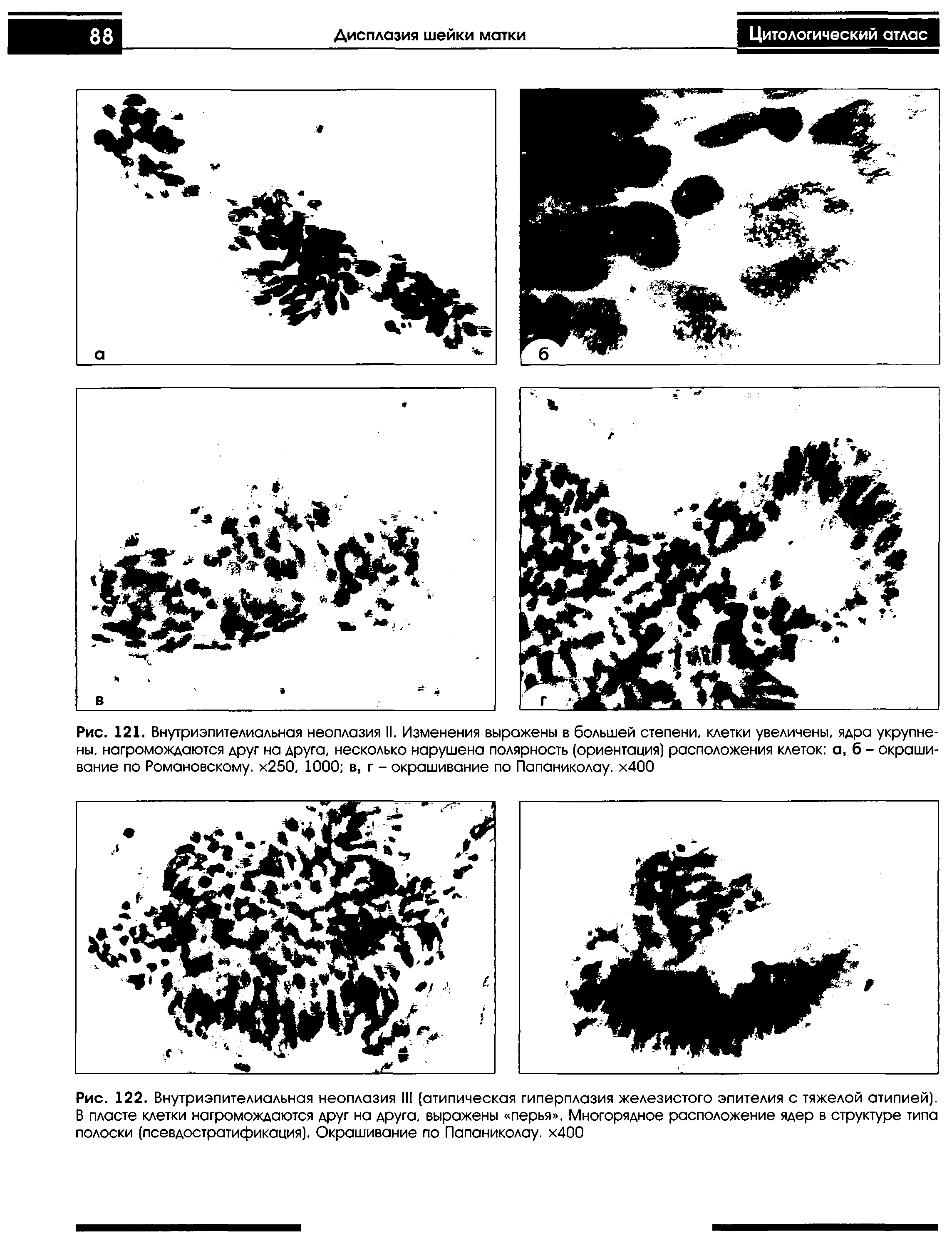 Рис. 121. Внутриэпителиальная неоплазия II. Изменения выражены в большей степени, клетки увеличены, ядра укрупнены, нагромождаются друг на друга, несколько нарушена полярность (ориентация) расположения клеток а, б - окрашивание по Романовскому. х250, 1000 в, г - окрашивание по Папаниколау. х400...