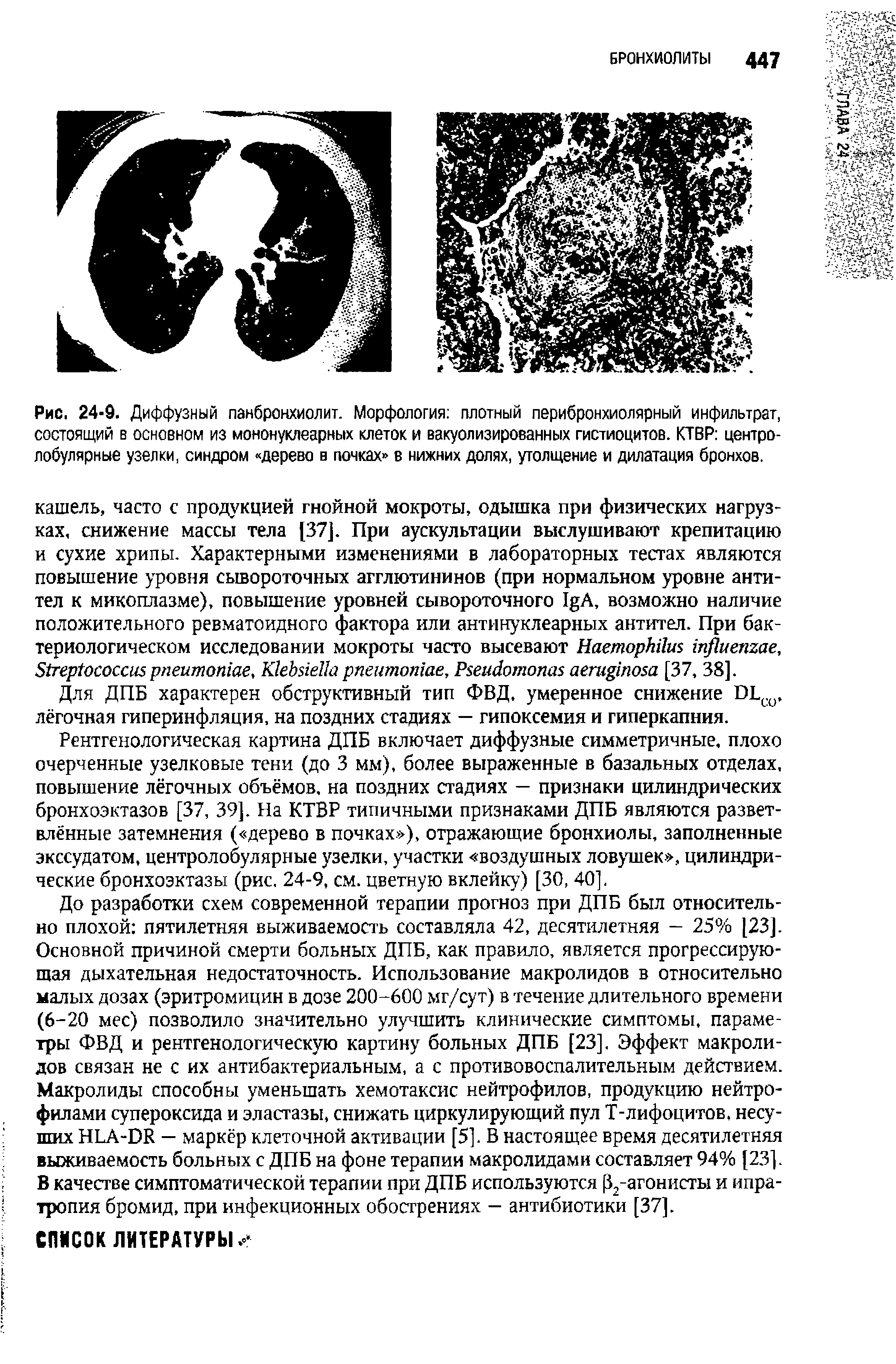 Рис. 24-9. Диффузный панбронхиолит. Морфология плотный перибронхиолярный инфильтрат, состоящий в основном из мононуклеарных клеток и вакуолизированных гистиоцитов. КТВР центролобулярные узелки, синдром дерево в почках в нижних долях, утолщение и дилатация бронхов.