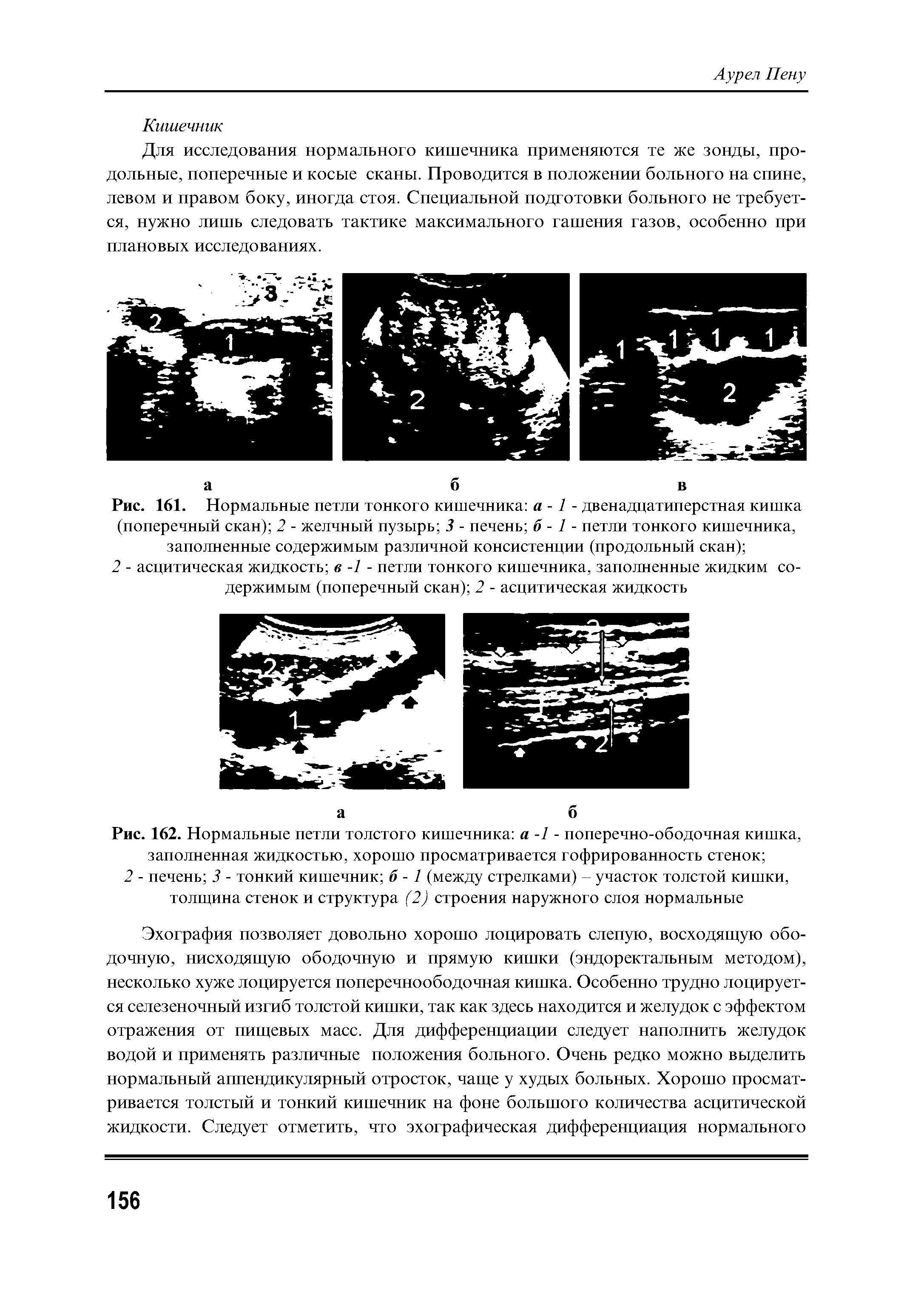 Рис. 161. Нормальные петли тонкого кишечника а -1 - двенадцатиперстная кишка (поперечный скан) 2 - желчный пузырь 3 - печень б - 1 - петли тонкого кишечника, заполненные содержимым различной консистенции (продольный скан) ...