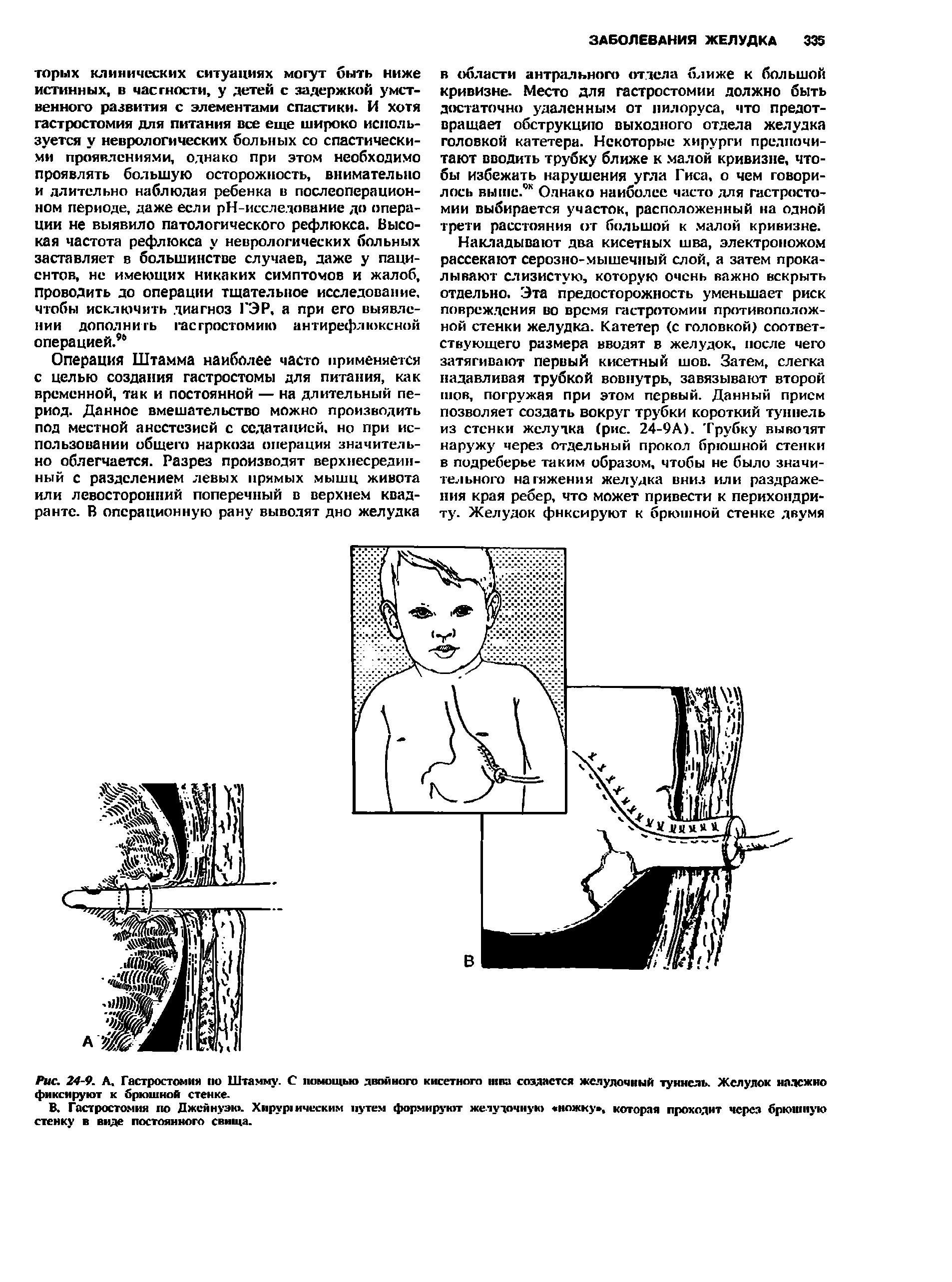 Рис. 24-9. А. Гастростомия по Штамму. С помощью двойного кисетного шва создается желудочный туннель. Желудок надежно фиксируют к брюшной стенке.