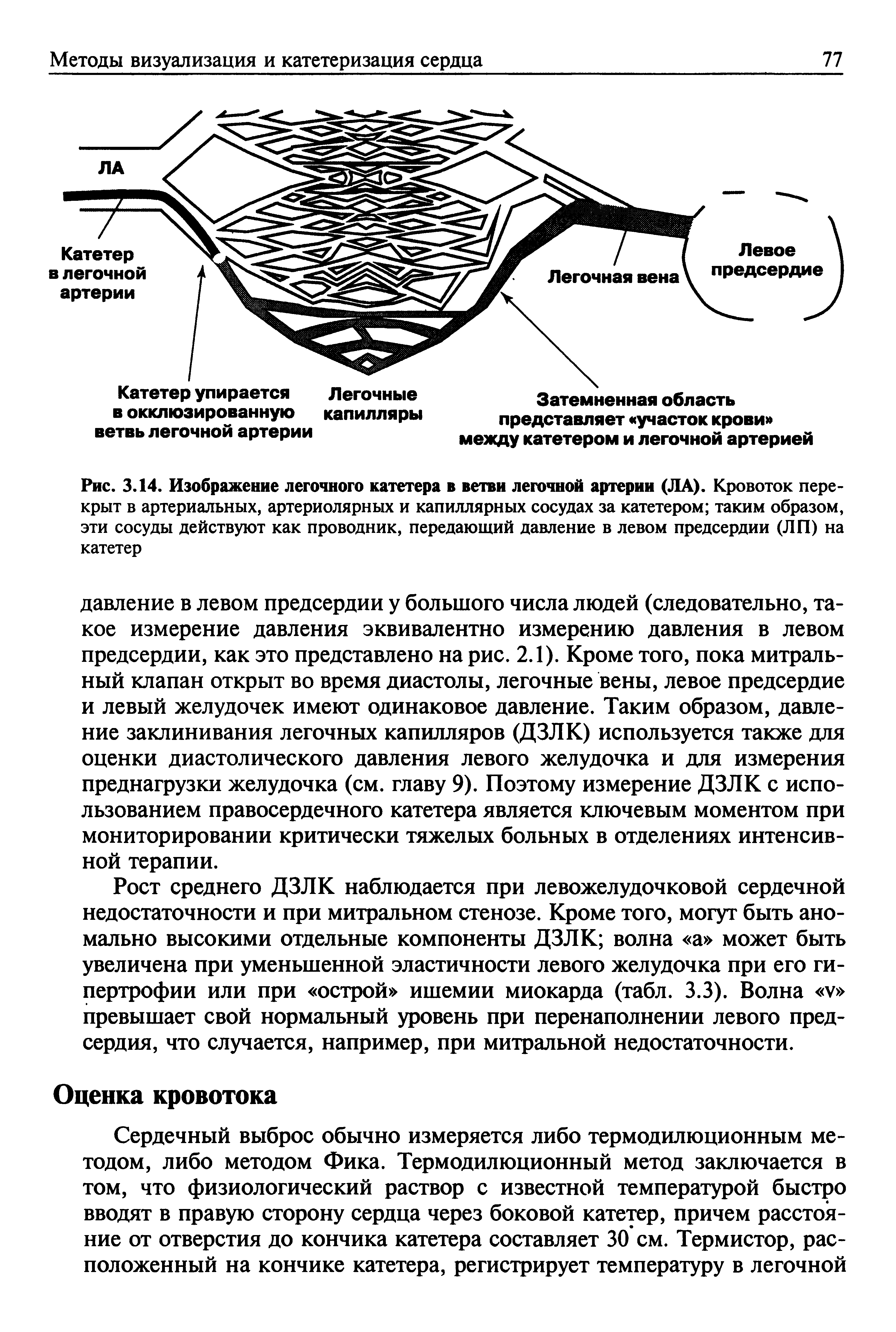 Рис. 3.14. Изображение легочного катетера в ветви легочной артерии (ЛА). Кровоток перекрыт в артериальных, артериолярных и капиллярных сосудах за катетером таким образом, эти сосуды действуют как проводник, передающий давление в левом предсердии (ЛП) на катетер...