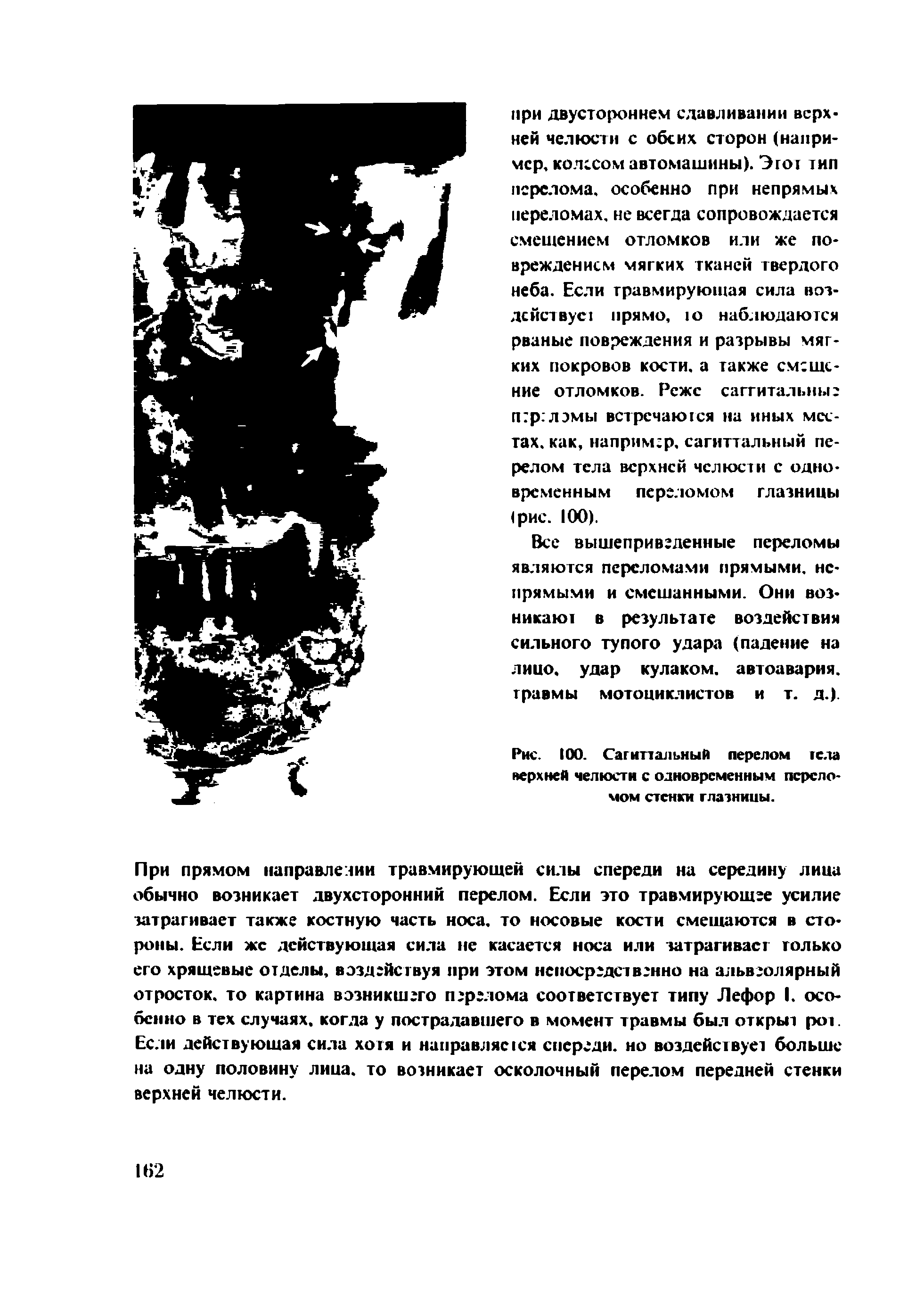 Рис. 100. Сагиттальный перелом тела верхней челюсти с одновременным переломом стенки глазницы.