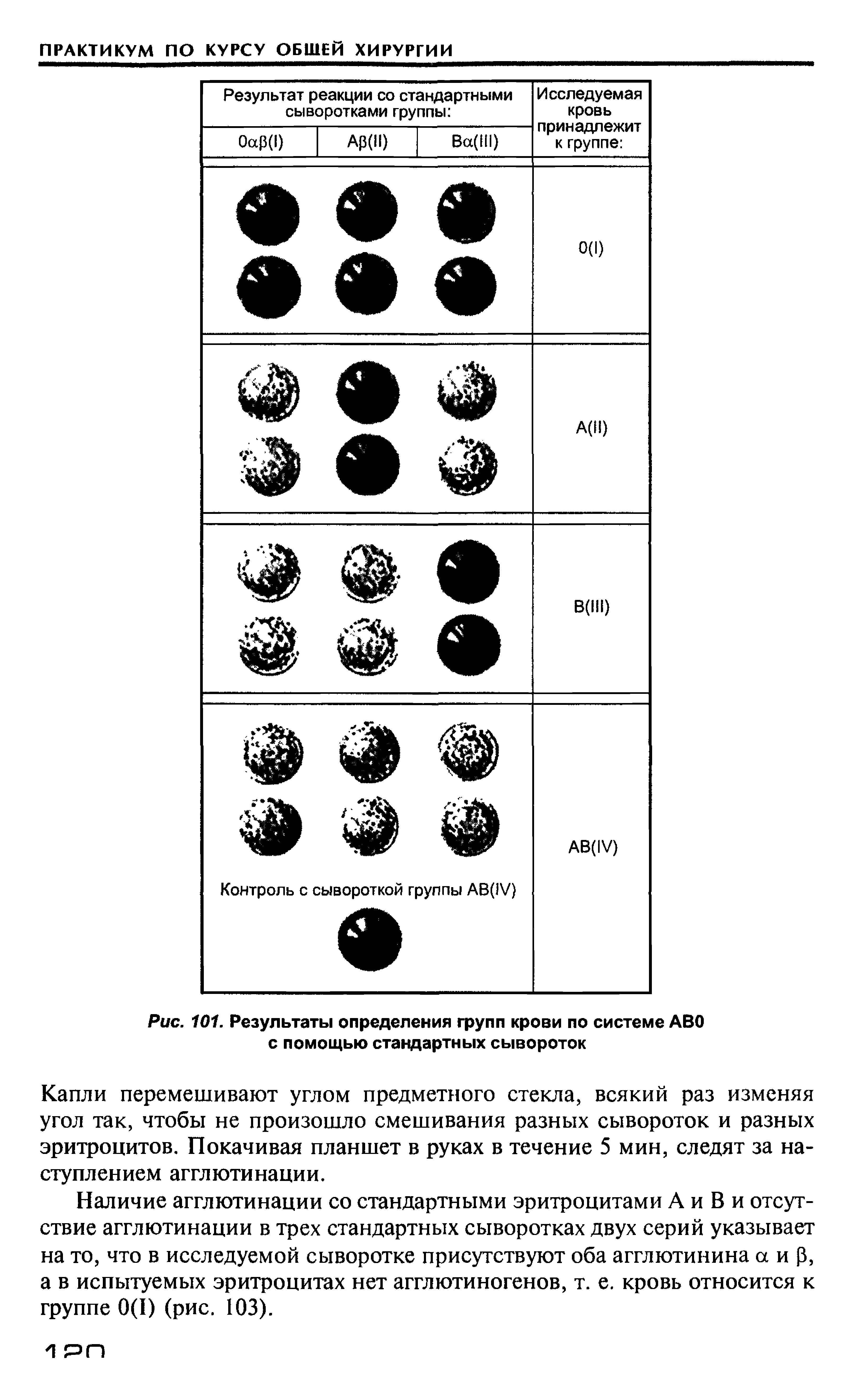 Рис. 101. Результаты определения групп крови по системе ABO с помощью стандартных сывороток...