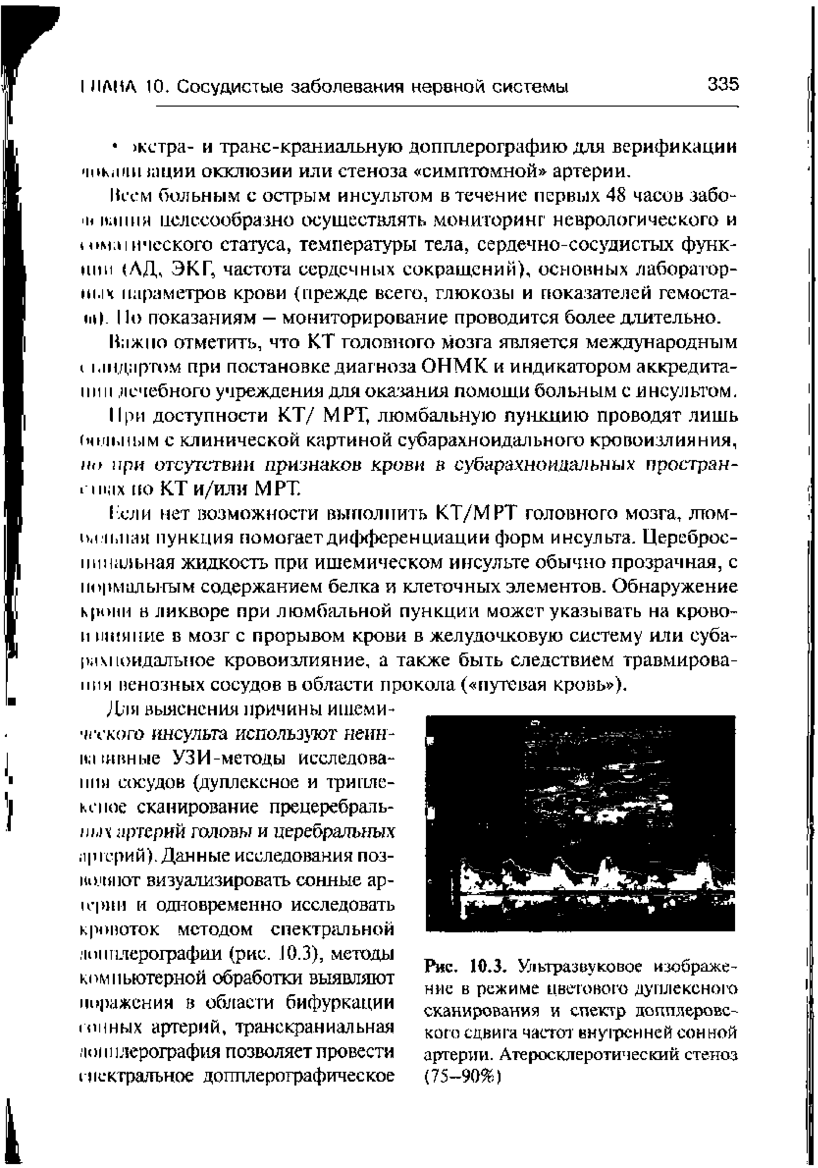 Рис. 10,3. Ультразвуковое изображение в режиме цветового дуплексного сканирования и спектр допплеровского сдвига частот внутренней сон ной артерии. Атеросклеротический стеноз (75-90%)...