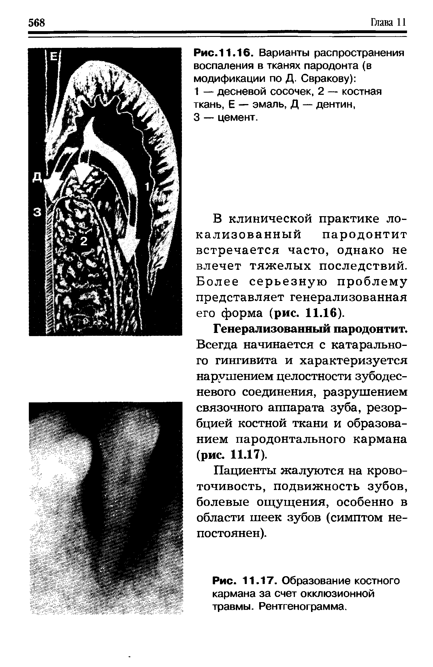 Рис. 11.17. Образование костного кармана за счет окклюзионной травмы. Рентгенограмма.