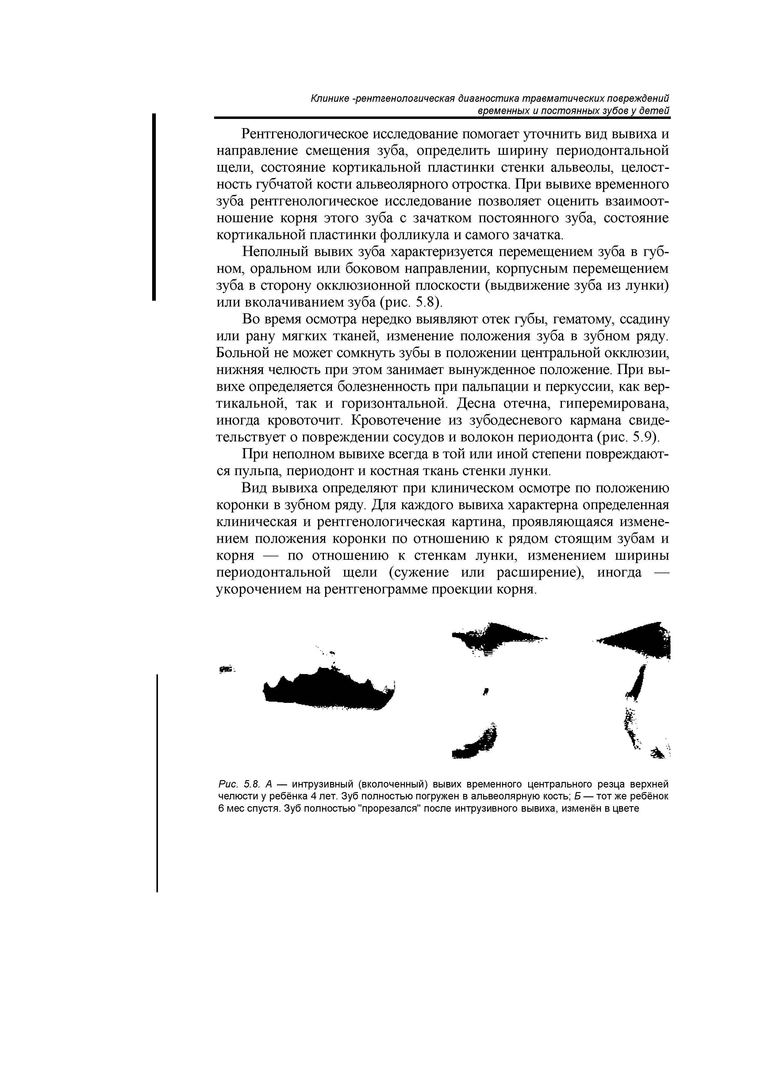 Рис. 5.8. А — интрузивный (вколоченный) вывих временного центрального резца верхней челюсти у ребёнка 4 лет. Зуб полностью погружен в альвеолярную кость Б — тот же ребёнок 6 мес спустя. Зуб полностью "прорезался" после интрузивного вывиха, изменён в цвете...