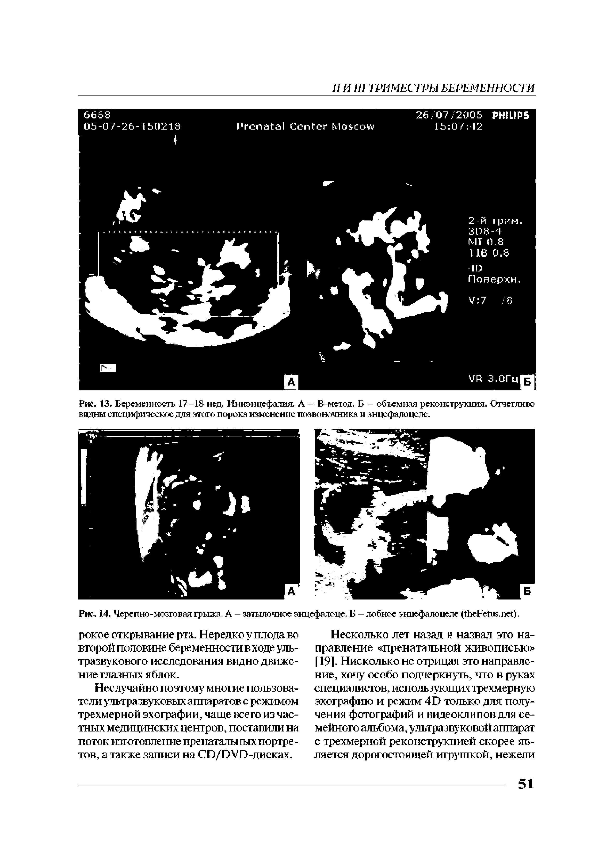 Рис. 14. Черепно-мозговая грыжа. А — затылочное энцефалоце. Б — лобное энцефалоцеле ( F . ).