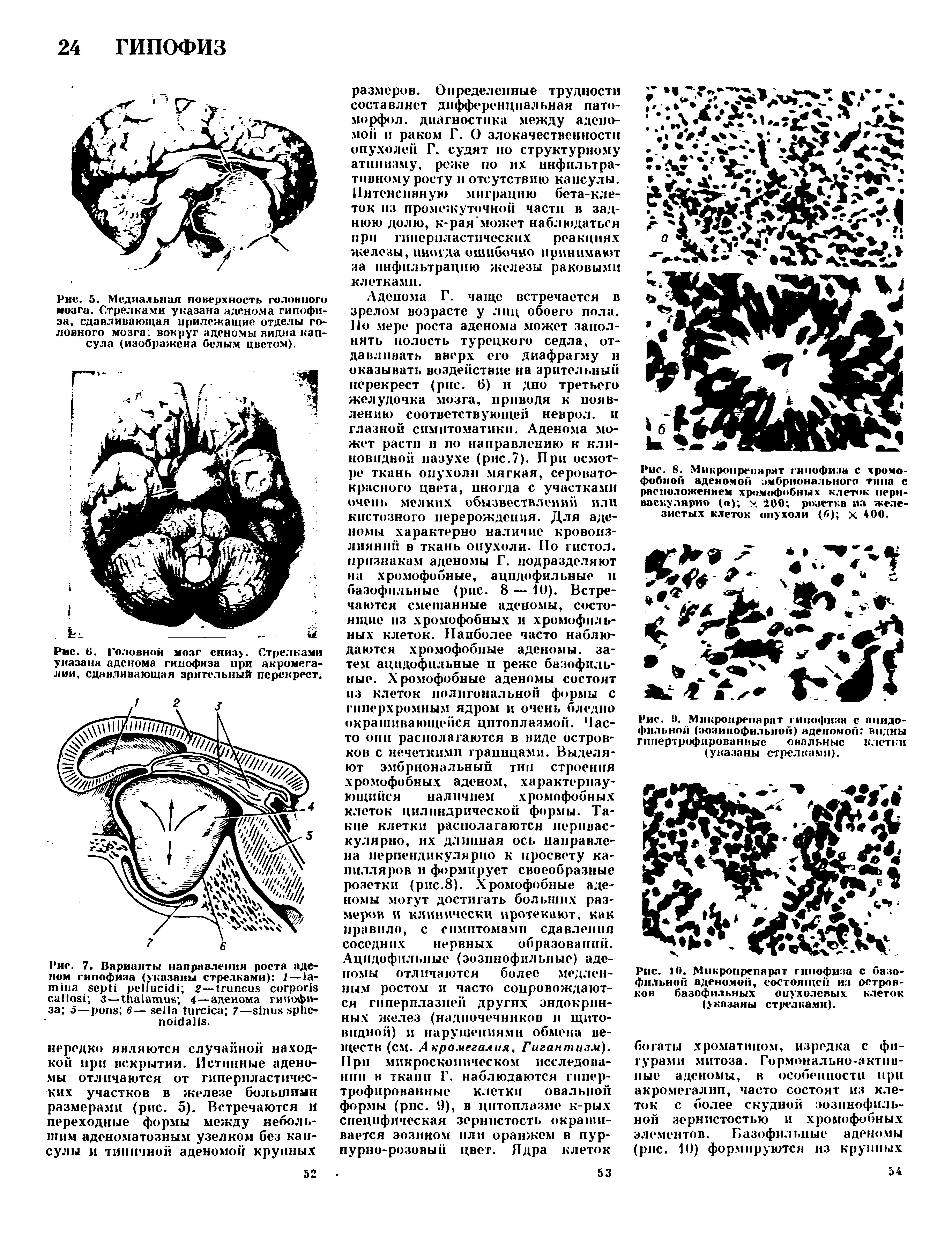 Рис. 5. Медиальная поверхность головного мозга. Стрелками указана аденома гипофиза, сдавливающая прилежащие отделы головного мозга вокруг аденомы видна капсула (изображена белым цветом).