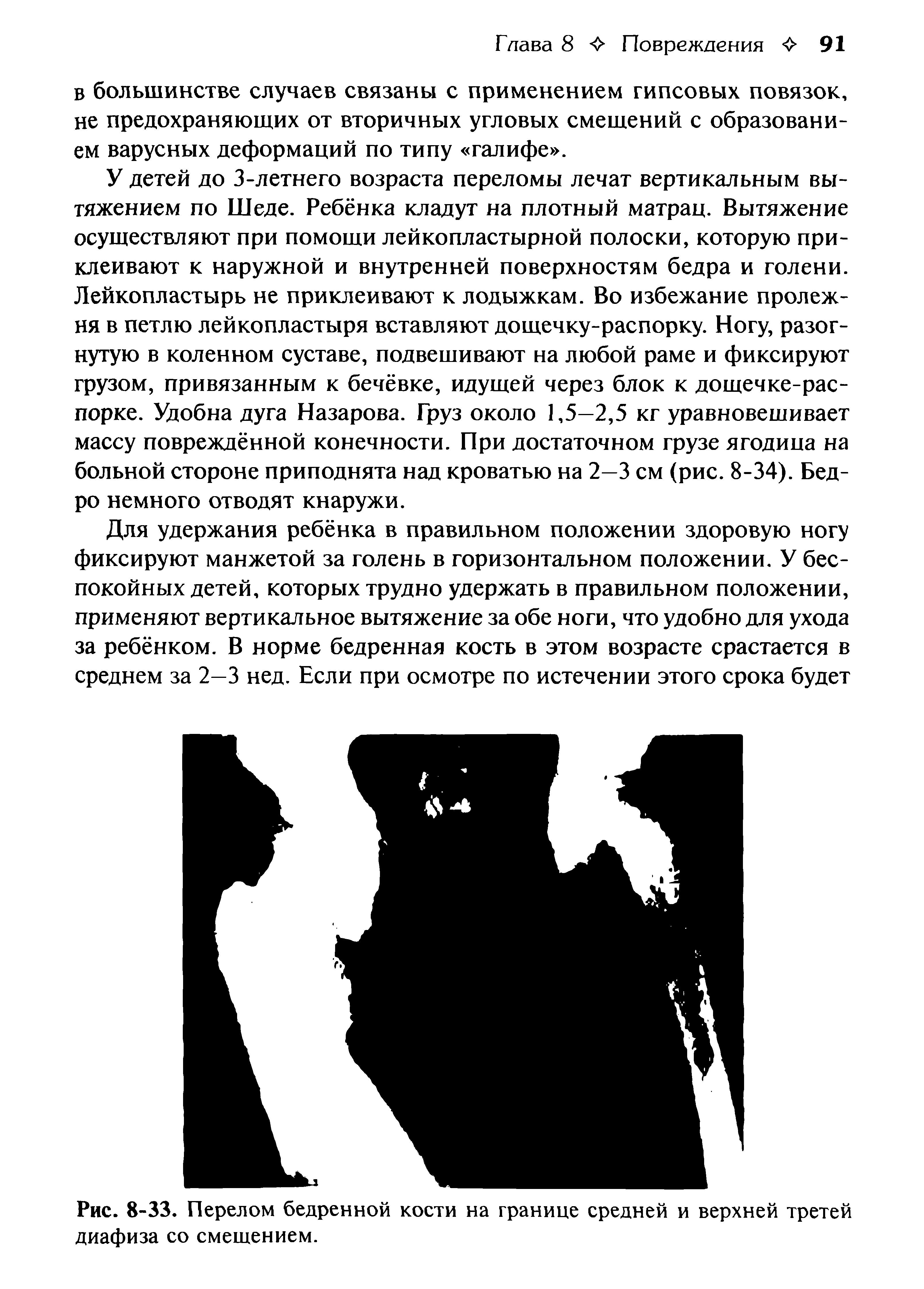 Рис. 8-33. Перелом бедренной кости на границе средней и верхней третей диафиза со смещением.