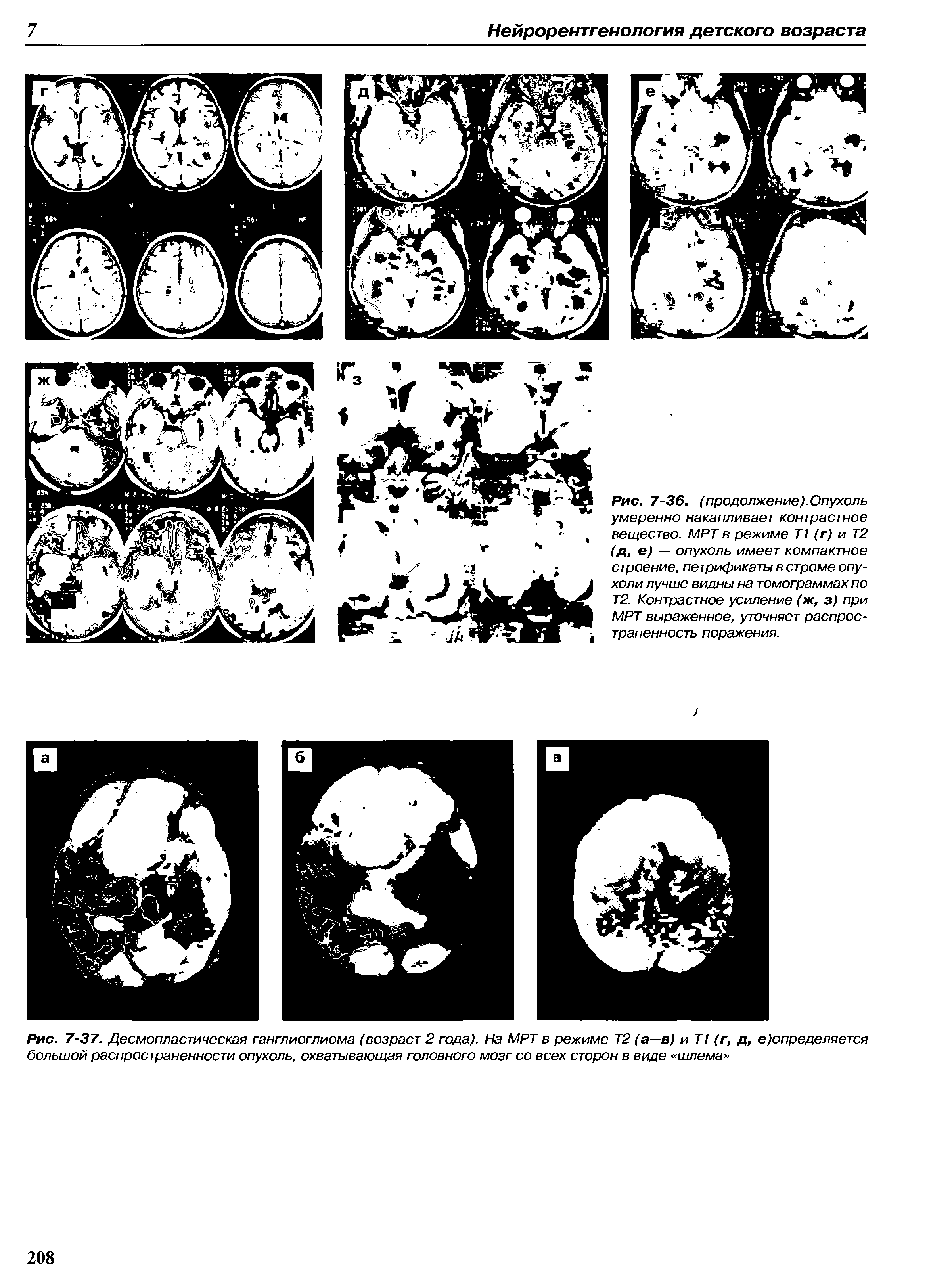 Рис. 7-37. Десмопластическая ганглиоглиома (возраст 2 года). На МРТ в режиме Т2 (а—в) и Т1 (г, д, е)определяется большой распространенности опухоль, охватывающая головного мозг со всех сторон в виде шлема ...