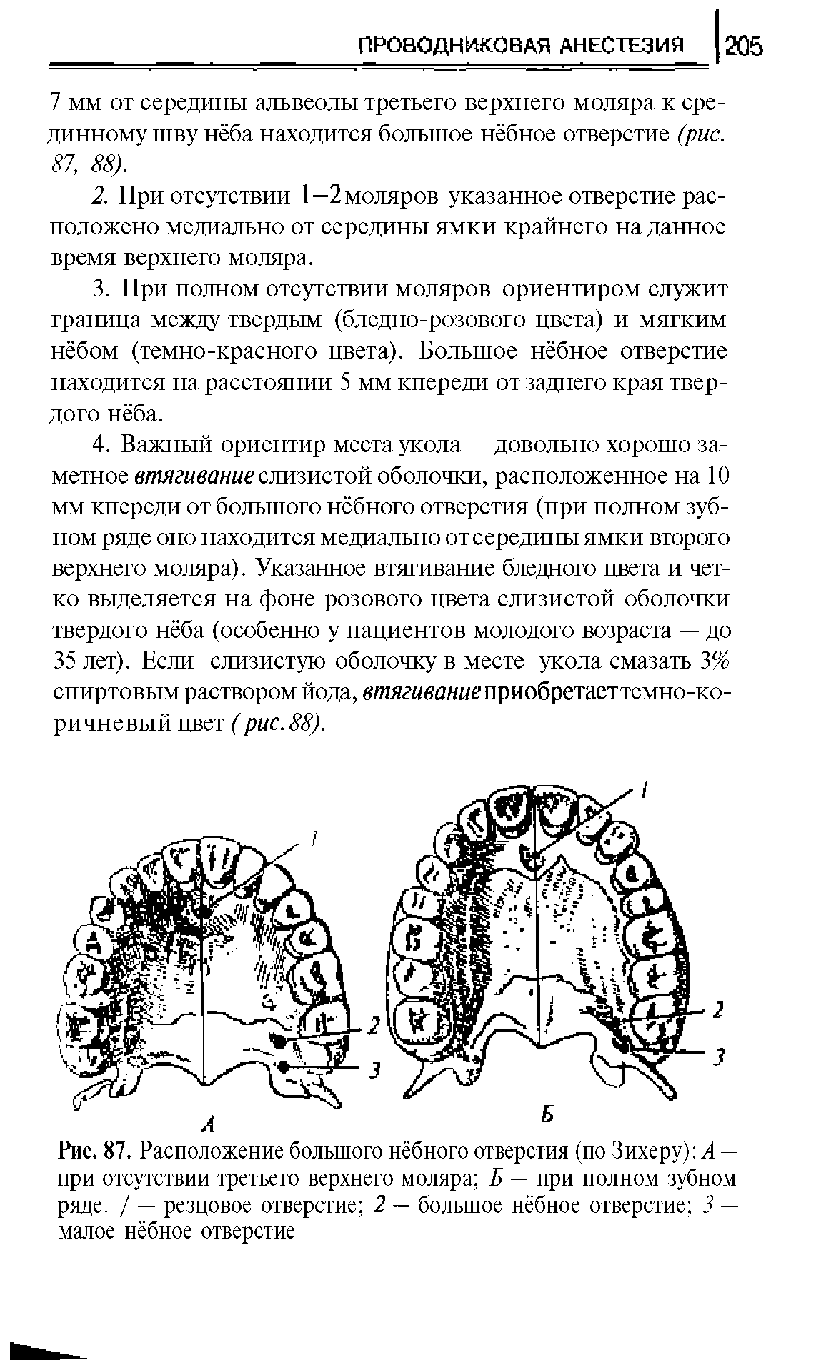 Рис. 87. Расположение большого нёбного отверстия (по Зихеру) А — при отсутствии третьего верхнего моляра Б — при полном зубном ряде. / — резцовое отверстие 2 — большое нёбное отверстие 3 — малое нёбное отверстие...