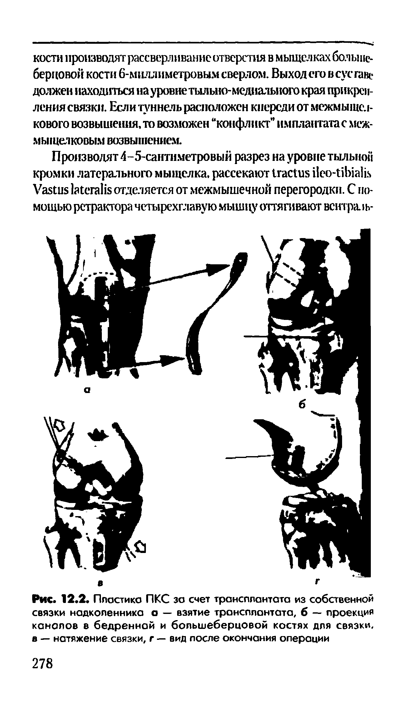 Рис. 12.2. Пластико ПКС за счет трансплантата из собственной связки надколенника а — взятие трансплантата, б — проекция каналов в бедренной и большеберцовой костях для связки, в — натяжение связки, г — вид после окончания операции...