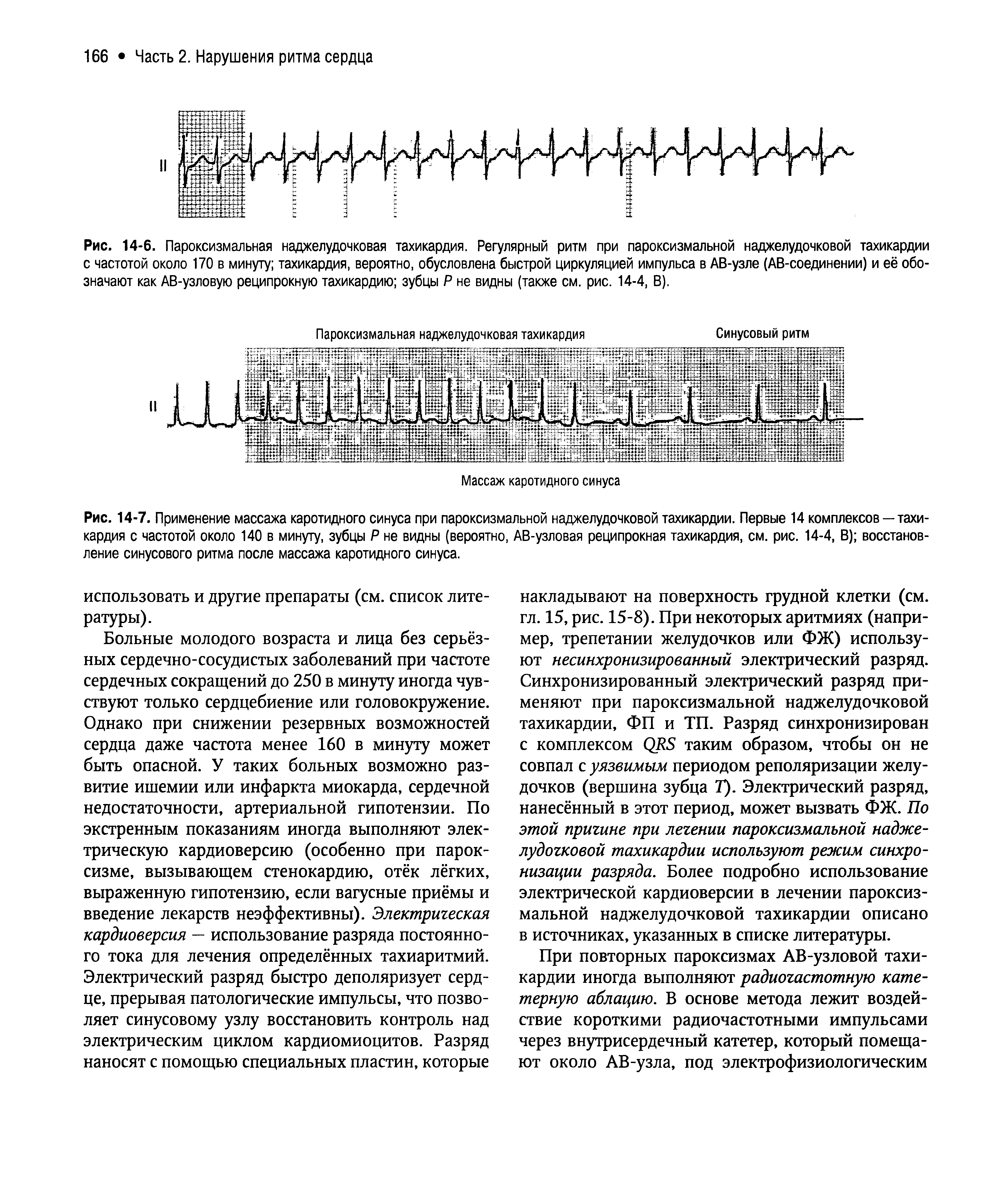 Рис. 14-6. Пароксизмальная наджелудочковая тахикардия. Регулярный ритм при пароксизмальной наджелудочковой тахикардии с частотой около 170 в минуту тахикардия, вероятно, обусловлена быстрой циркуляцией импульса в АВ-узле (АВ-соединении) и её обозначают как АВ-узловую реципрокную тахикардию зубцы Р не видны (также см. рис. 14-4, В).