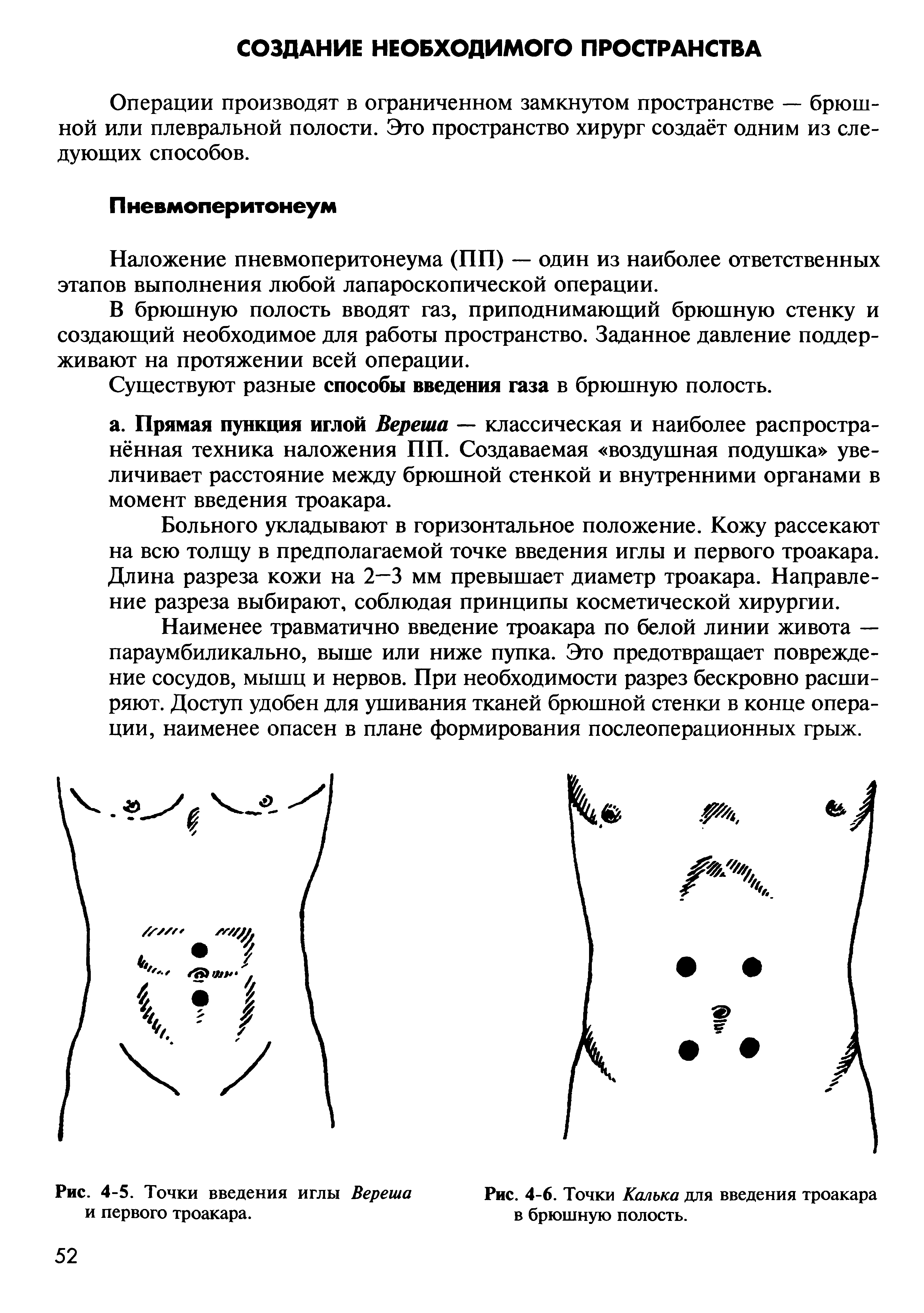 Рис. 4-6. Точки Калька для введения троакара в брюшную полость.