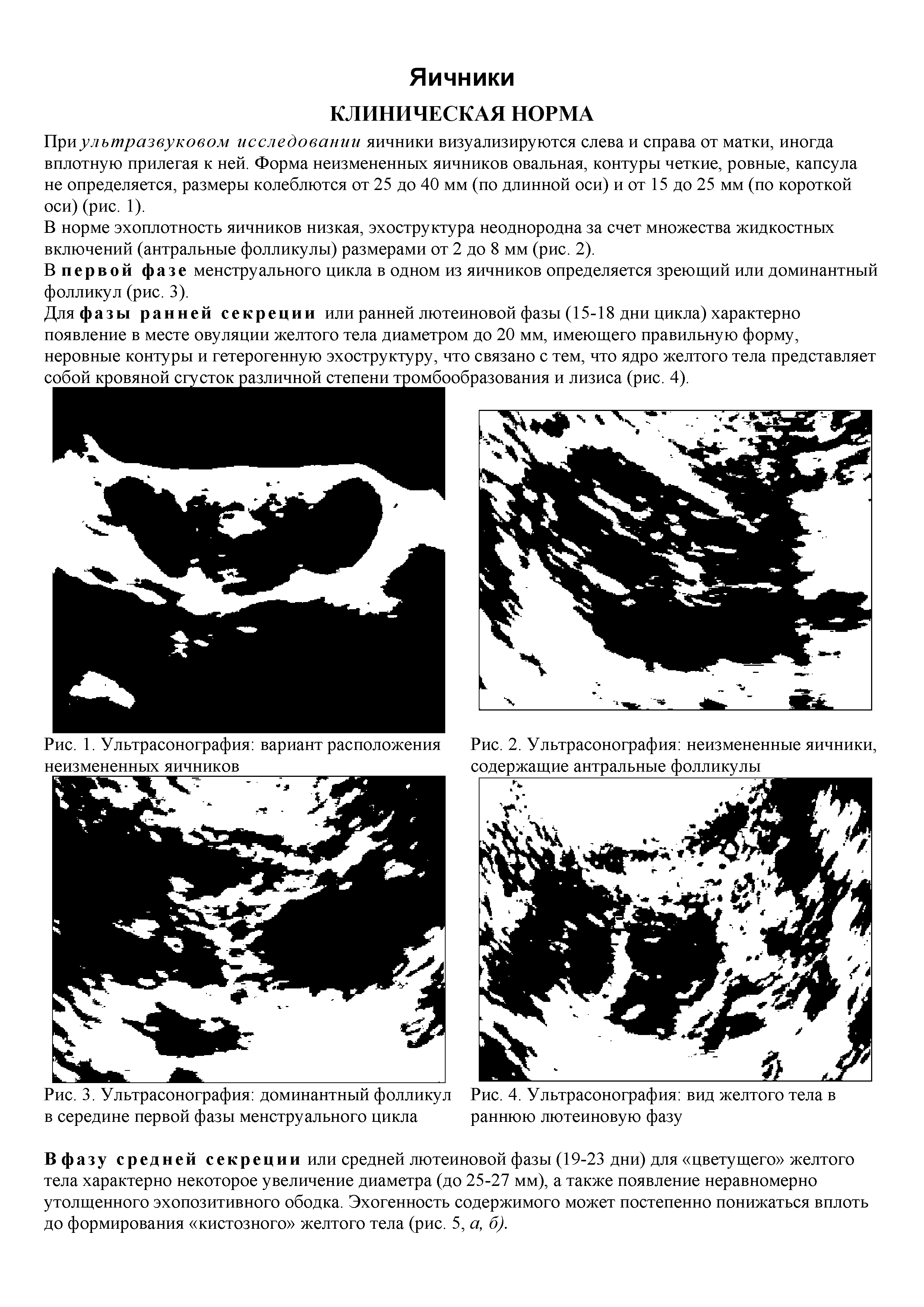 Рис. 2. Ультрасонография неизмененные яичники, содержащие антральные фолликулы...