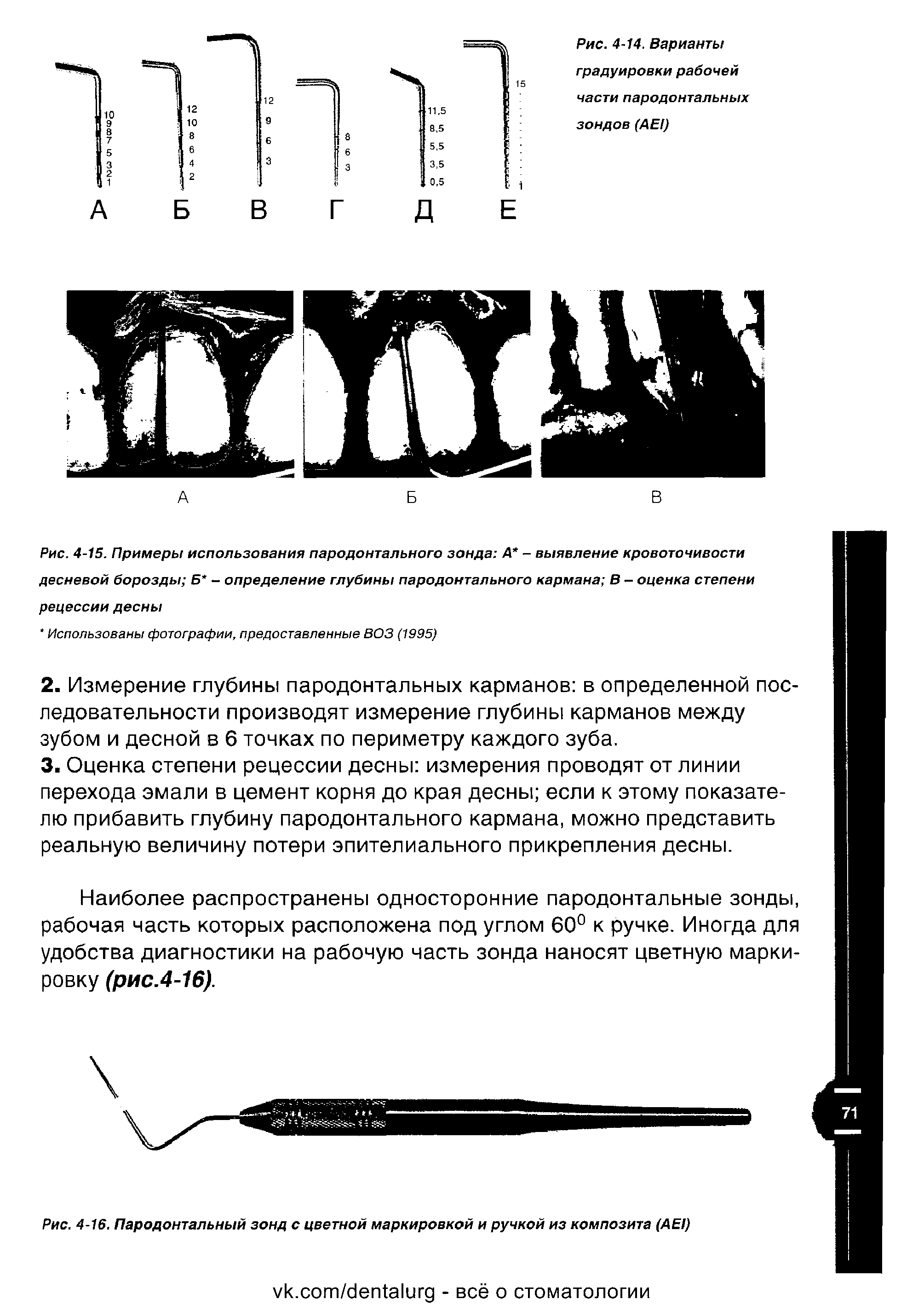 Рис. 4-15. Примеры использования пародонтального зонда А - выявление кровоточивости десневой борозды Б - определение глубины пародонтального кармана В - оценка степени рецессии десны...