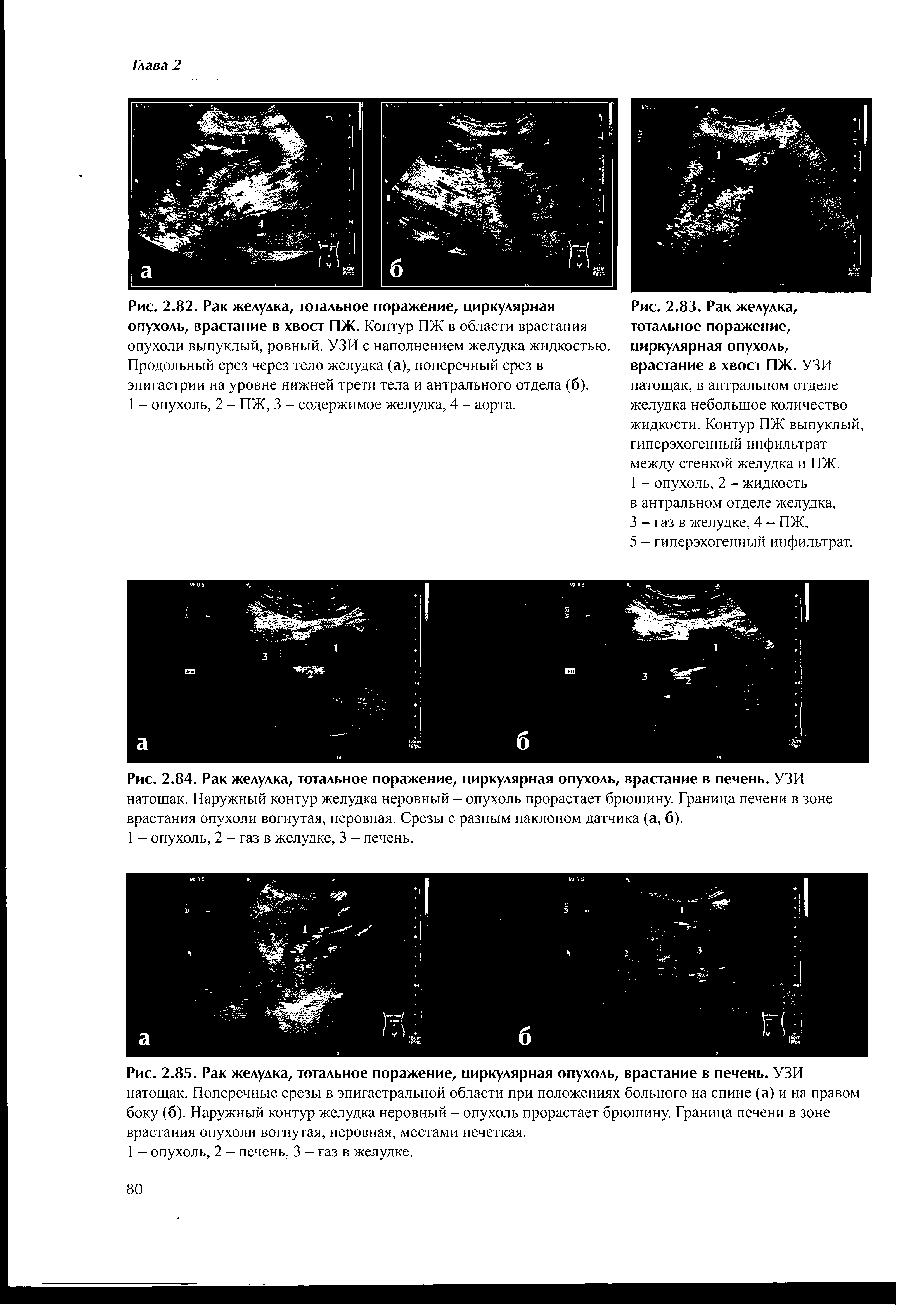 Рис. 2.82. Рак желудка, тотальное поражение, циркулярная опухоль, врастание в хвост ПЖ. Контур ПЖ в области врастания опухоли выпуклый, ровный. УЗИ с наполнением желудка жидкостью. Продольный срез через тело желудка (а), поперечный срез в эпигастрии на уровне нижней трети тела и антрального отдела (б).