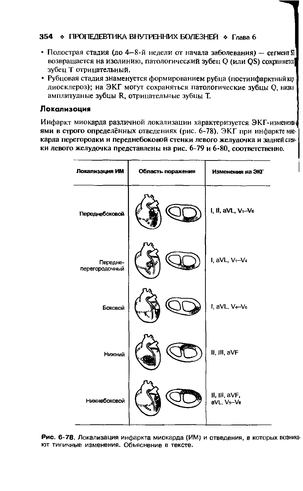 Рис. 6-78. Локализация инфаркта миокарда (ИМ) и отведения, в которых возникают типичные изменения. Объяснение в тексте.