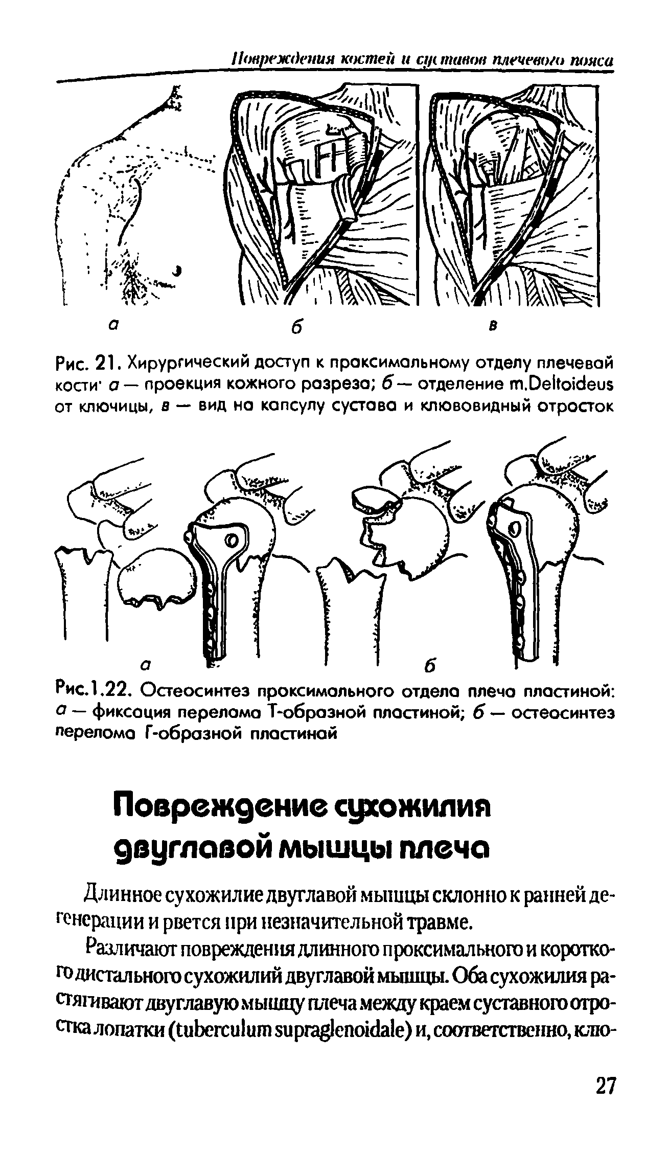 Рис. 21. Хирургический доступ к проксимальному отделу плечевой кости а — проекция кожного разреза б— отделение т.0екок1еи от ключицы, в — вид на капсулу сустава и клювовидный отросток...